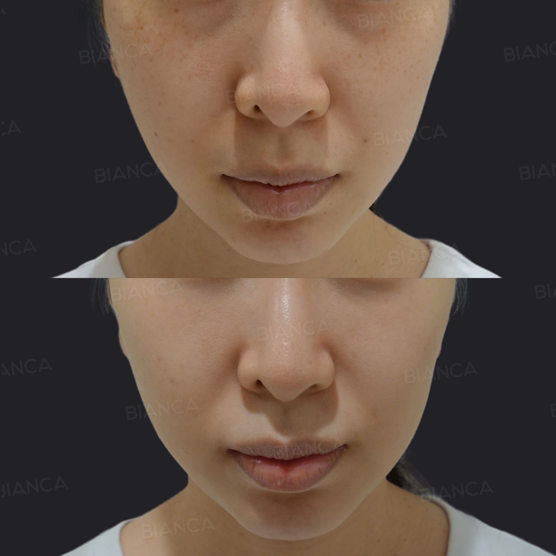 ピコスポット、ピコトーニング