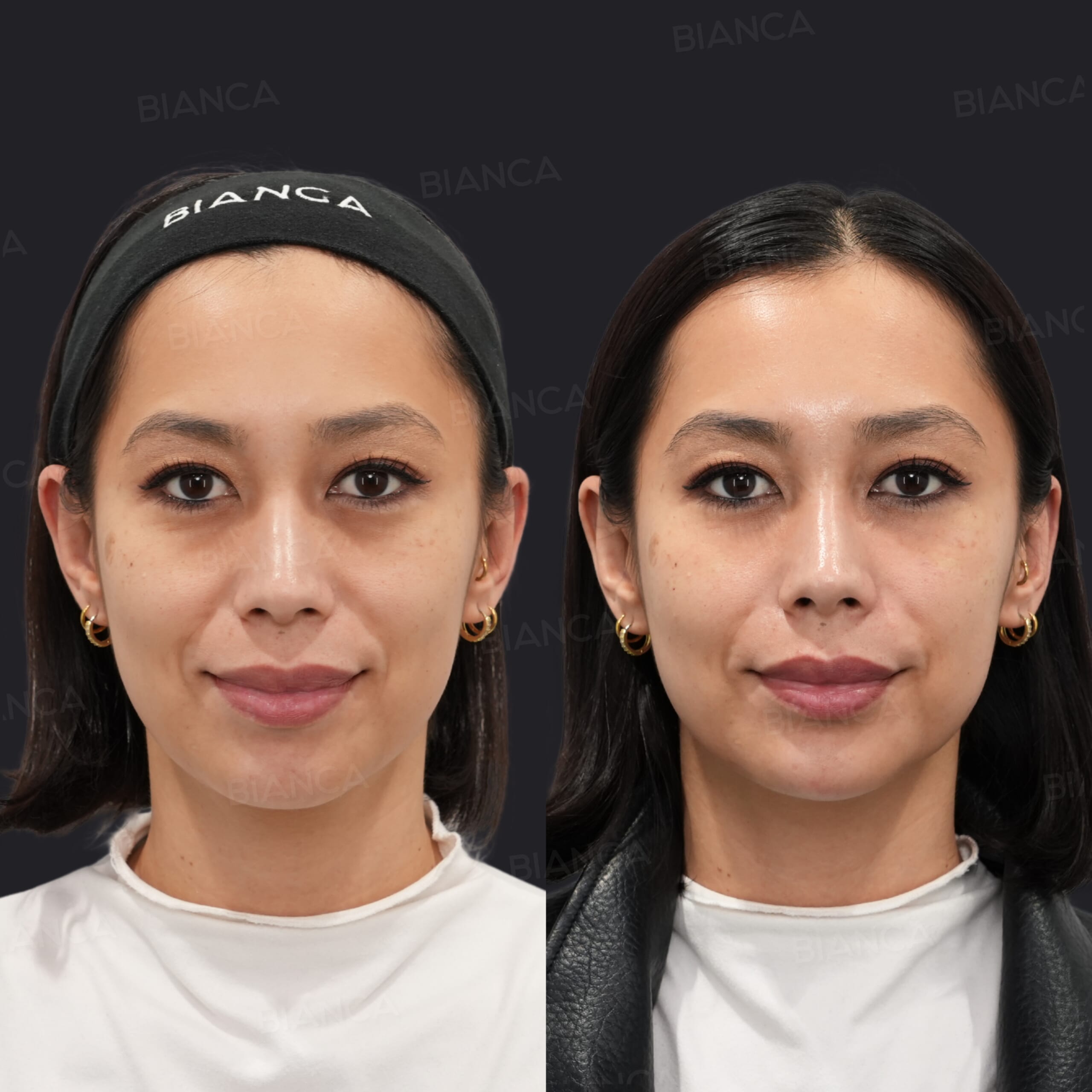 ヒアルロ酸注射(ほうれい線、ゴルゴライン、顎)、ベビーコラーゲン