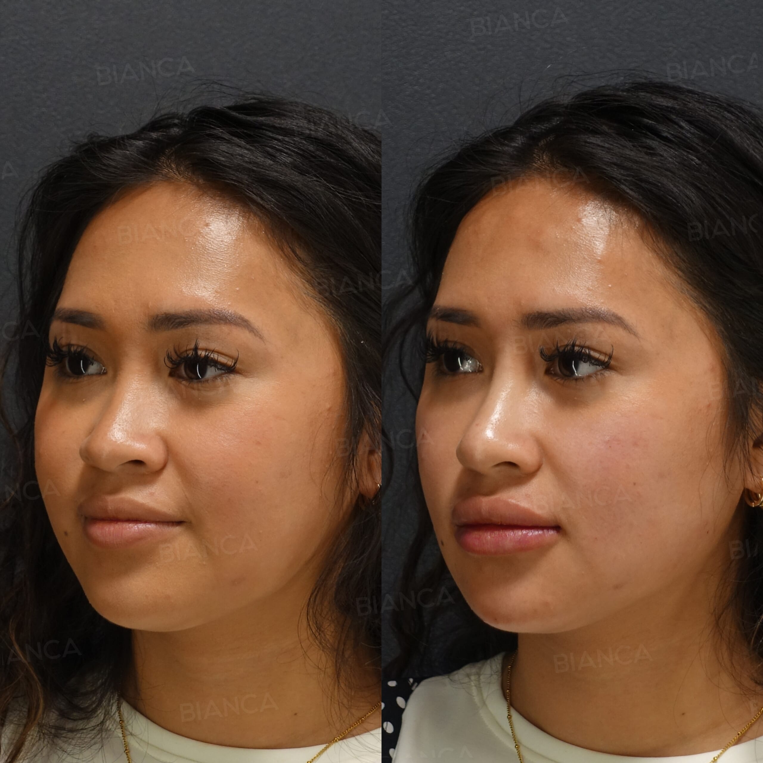 ヒアルロン酸注射(鼻先、唇）