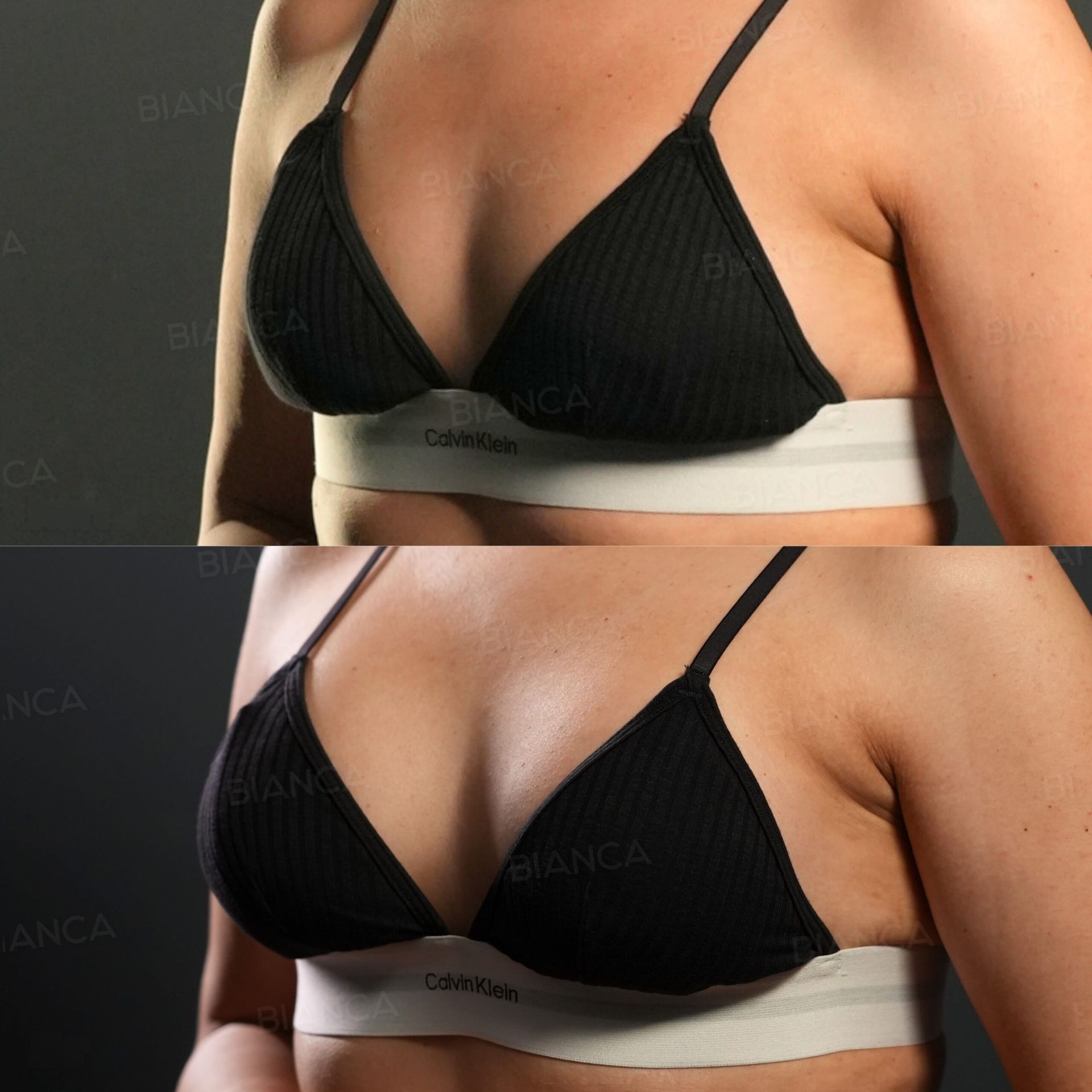 プリザベ(シリコンバッグ豊胸)