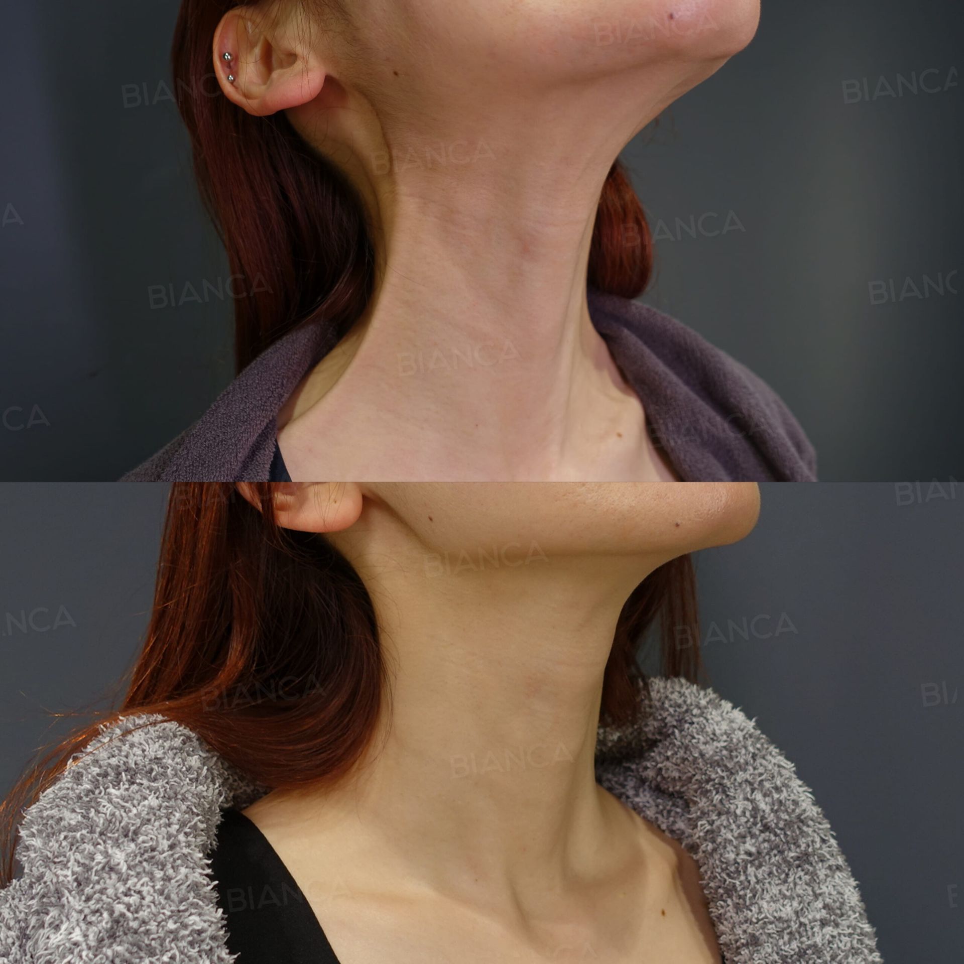 ボトックス注射(広頸筋)