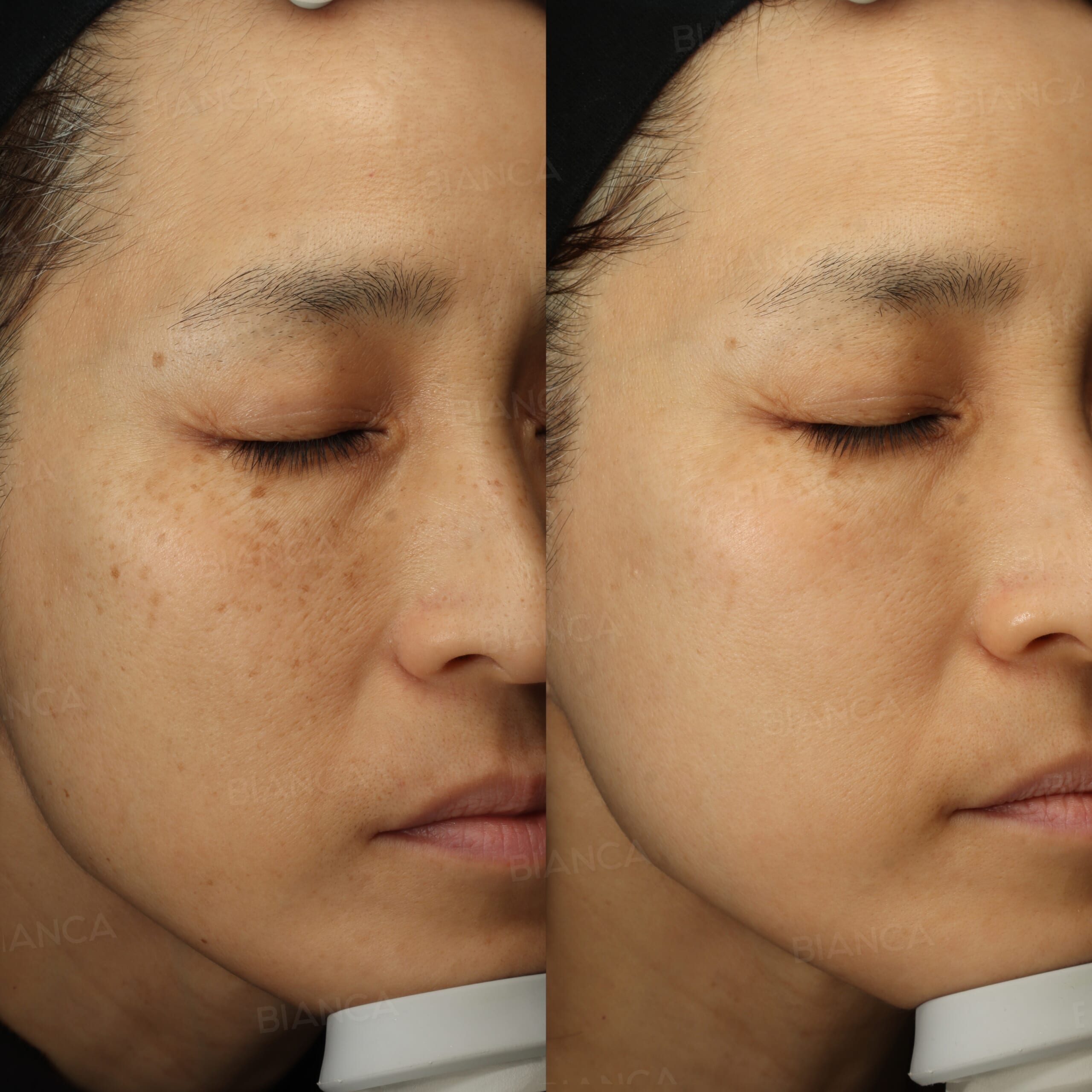 ルメッカ、メソナJ