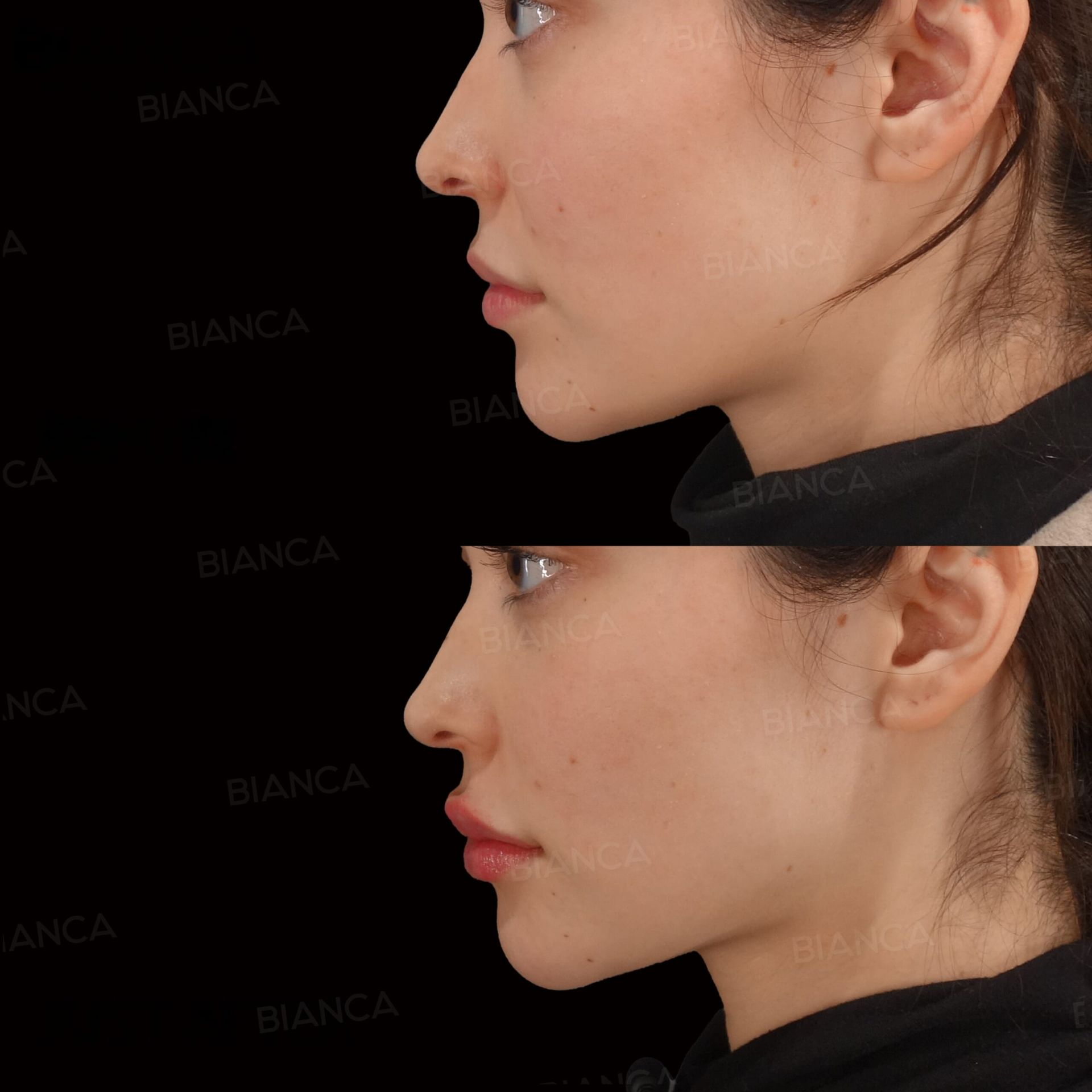 ヒアルロン酸注射(唇)