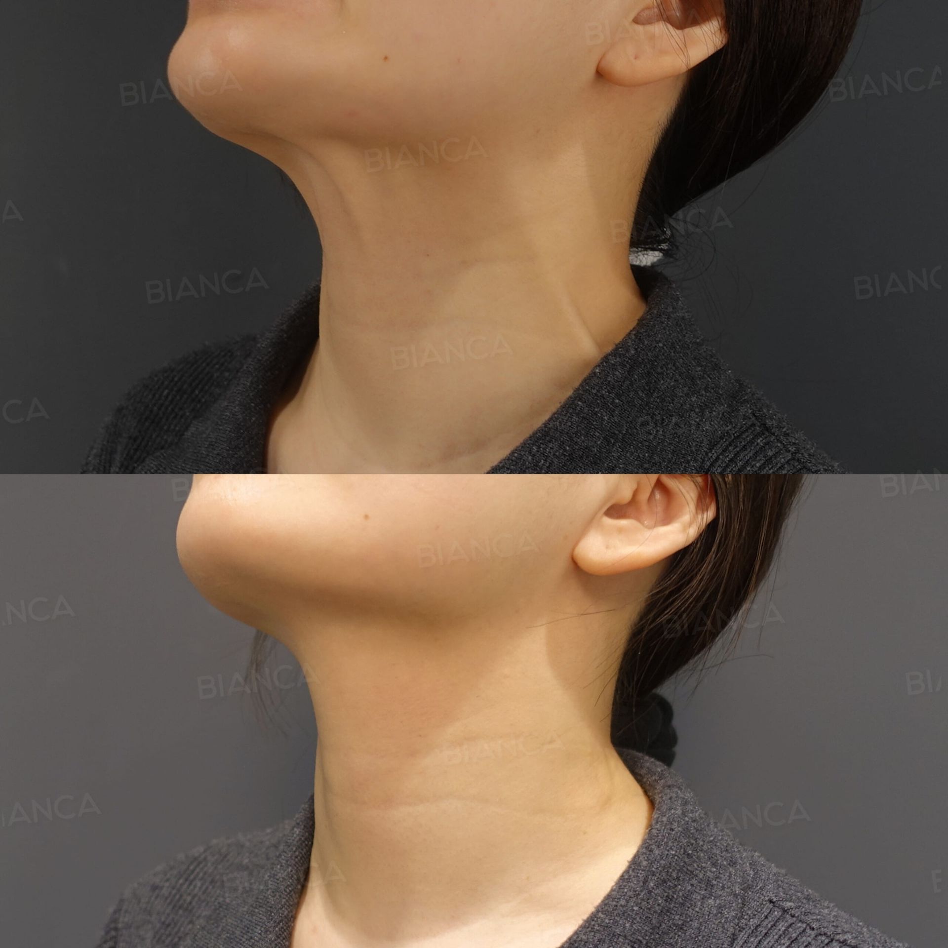 ボトックス注射(広頸筋)