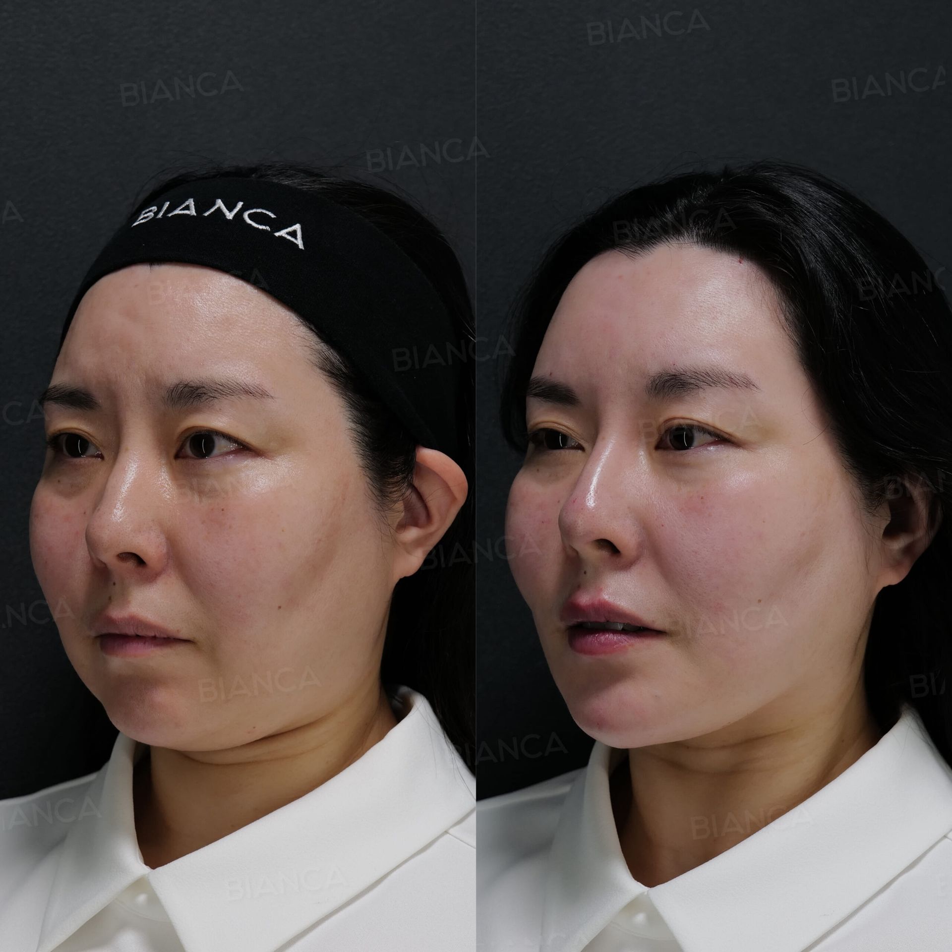 ヒアルロン酸注射(額、鼻、唇、顎)、BIANCA LIFT
