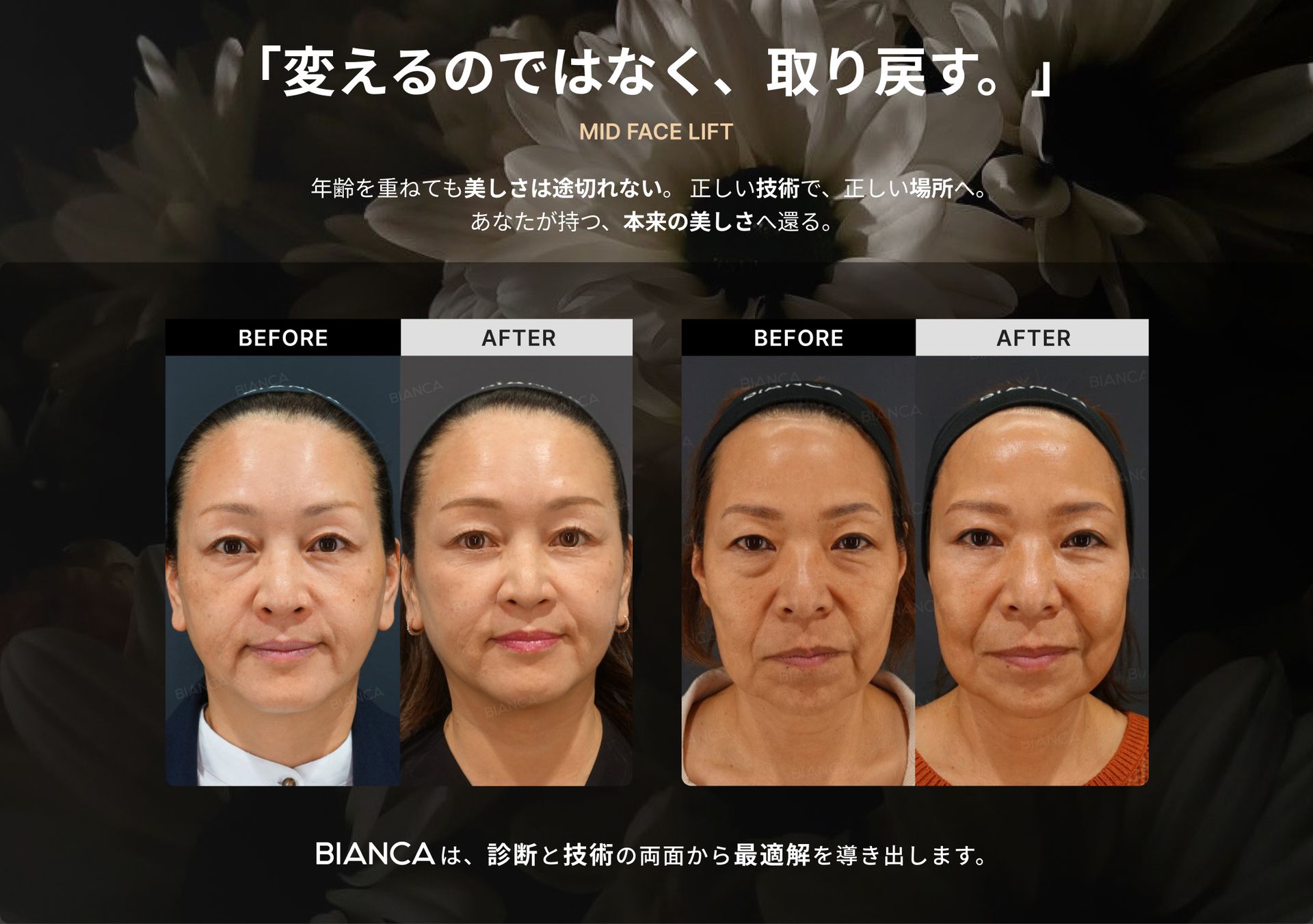ミッドフェイスリフト リッチ銀座・表参道にあるBIANCA CLINIC ビアンカクリニック｜美容外科・美容皮膚科・再生医療・美容婦人科・美容内科
