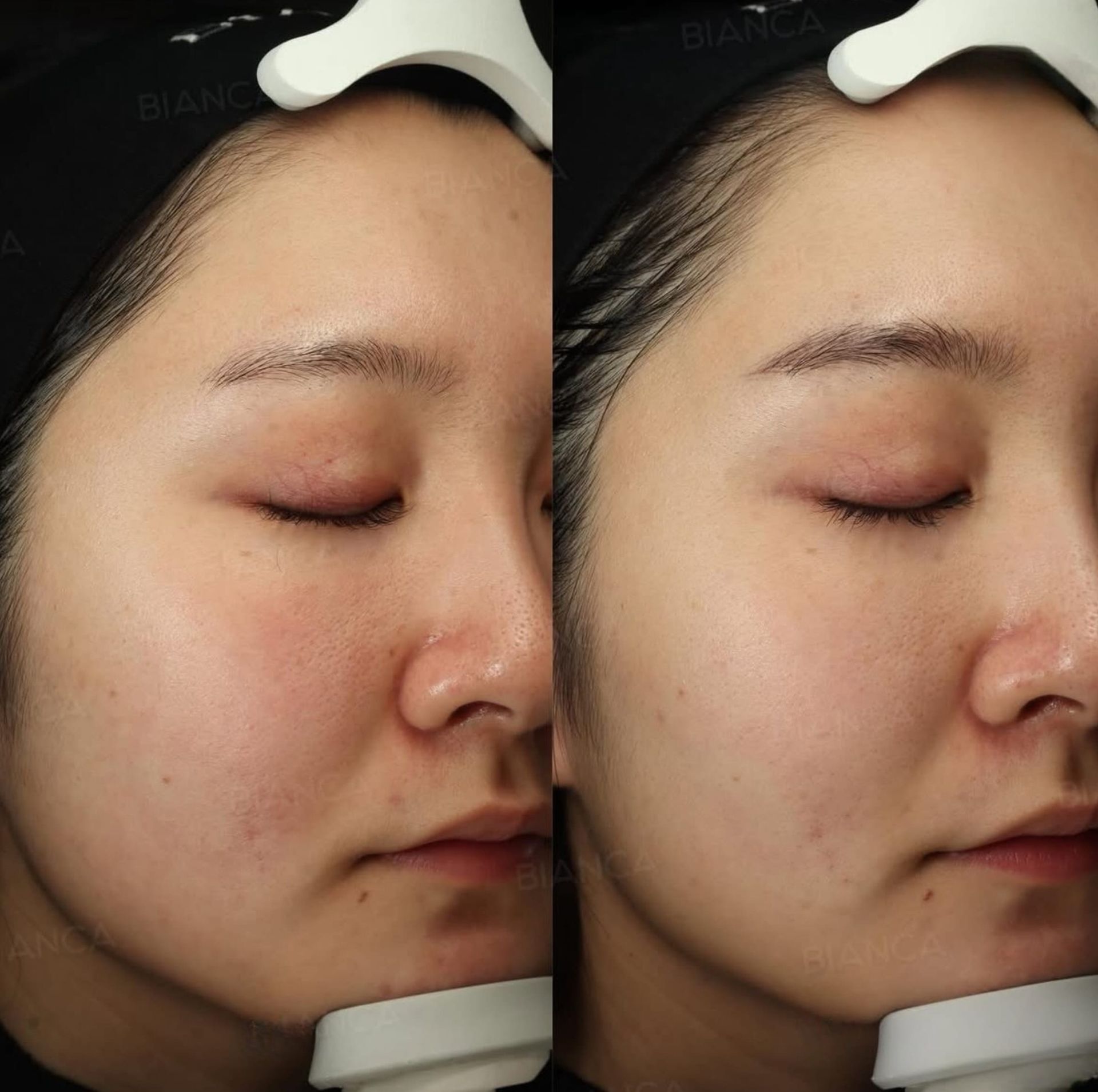 アドバテックスレーザー(2波長 全顔照射)｜銀座・表参道にあるBIANCA CLINIC ビアンカクリニック｜美容外科・美容皮膚科・再生医療・美容婦人科・美容内科・医療アートメイク