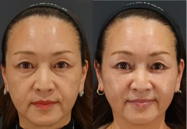 ミッドフェイスリフト 銀座・表参道にあるBIANCA CLINIC ビアンカクリニック|美容外科・美容皮膚科・再生医療・美容婦人科・美容内科