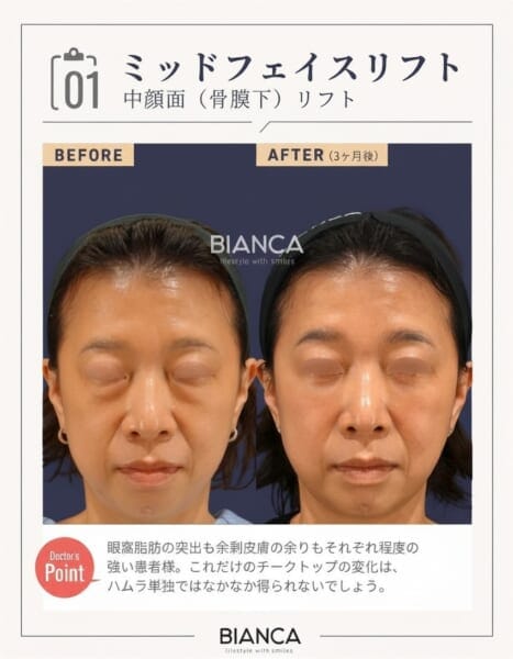 ミッドフェイスリフト症例g 銀座・表参道にあるBIANCA CLINIC ビアンカクリニック|美容外科・美容皮膚科・再生医療・美容婦人科・美容内科