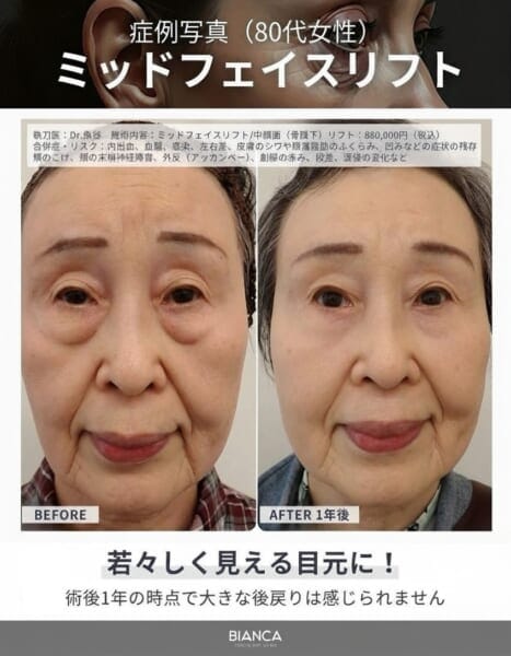ミッドフェイスリフト症例 銀座・表参道にあるBIANCA CLINIC ビアンカクリニック|美容外科・美容皮膚科・再生医療・美容婦人科・美容内科