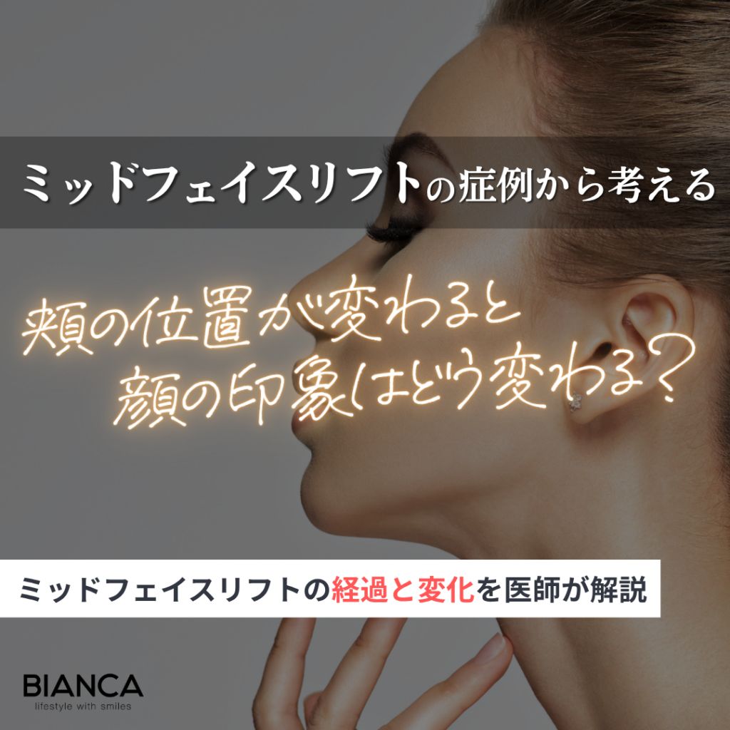 ミッドフェイスリフトの症例｜頬の位置で印象はどう変わる？経過・変化と適応を形成外科医が解説