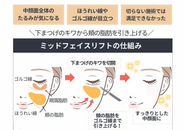 ミッドフェイスリフト 銀座・表参道にあるBIANCA CLINIC ビアンカクリニック|美容外科・美容皮膚科・再生医療・美容婦人科・美容内科
