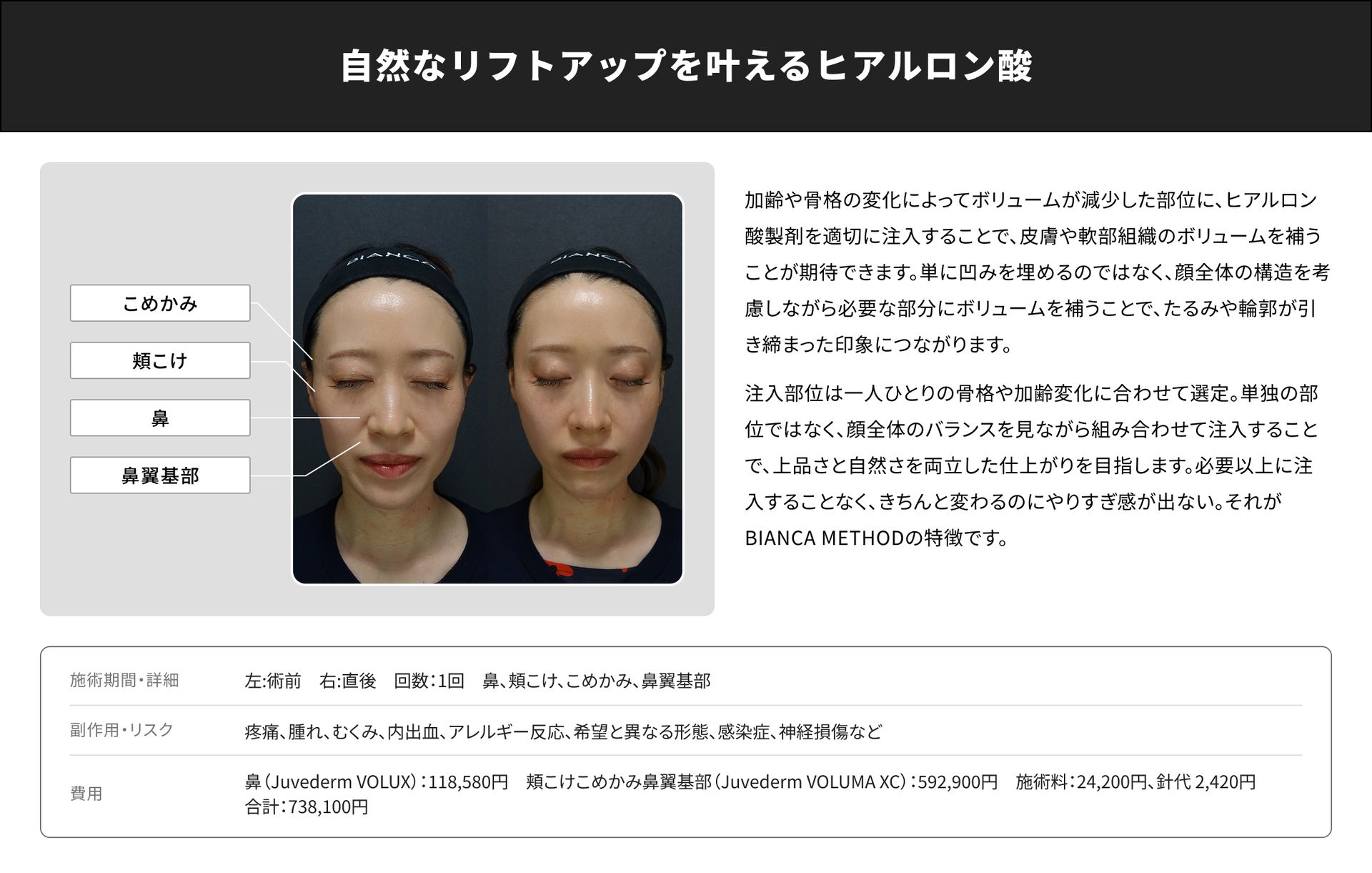 ヒアルロン酸注射｜銀座・表参道にあるBIANCA CLINIC ビアンカクリニック｜美容外科・美容皮膚科・再生医療・美容婦人科・美容内科