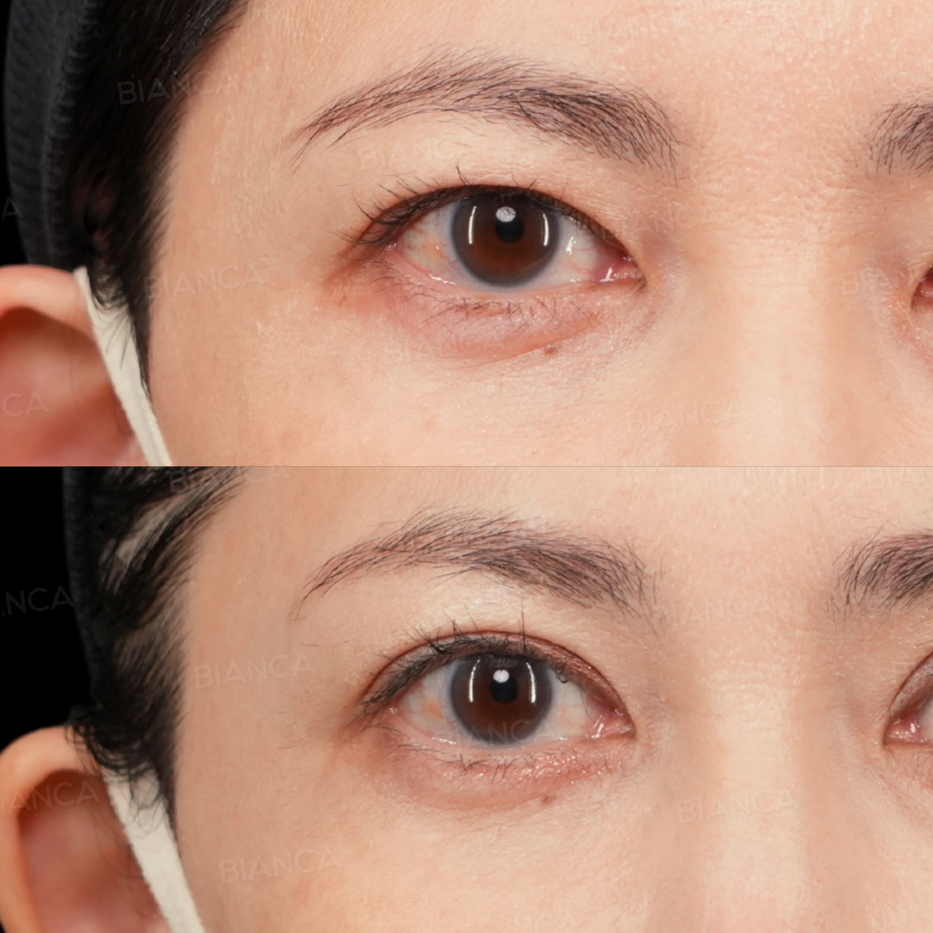二重切開、上瞼たるみ取り