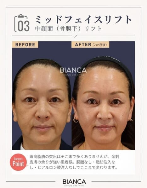 ミッドフェイスリフト症例 銀座・表参道にあるBIANCA CLINIC ビアンカクリニック|美容外科・美容皮膚科・再生医療・美容婦人科・美容内科