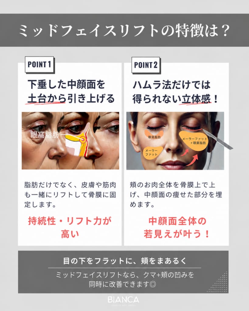 ミッドフェイスリフトの特徴を示した図