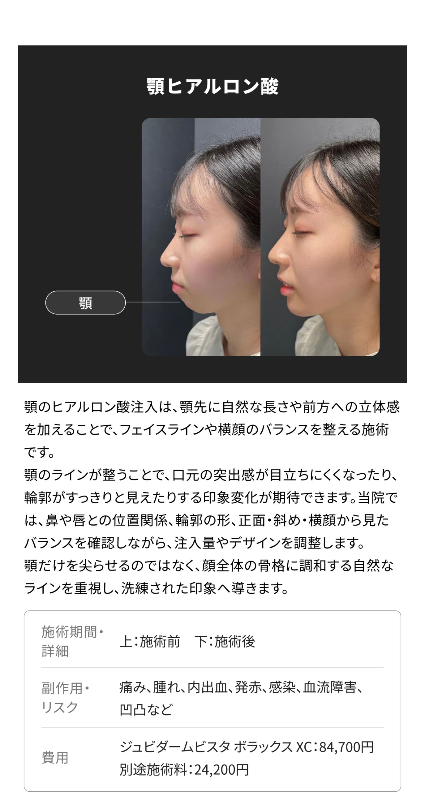 ヒアルロン酸注射 銀座・表参道にあるBIANCA CLINIC ビアンカ