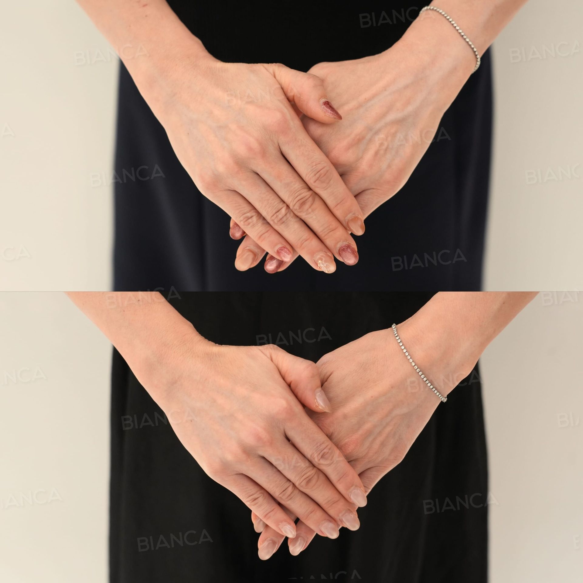 GOURI(手の甲)