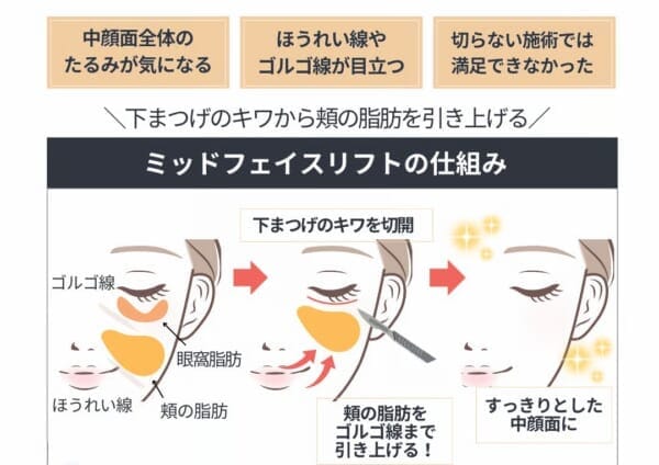 ミッドフェイスリフトの仕組みを解説する図