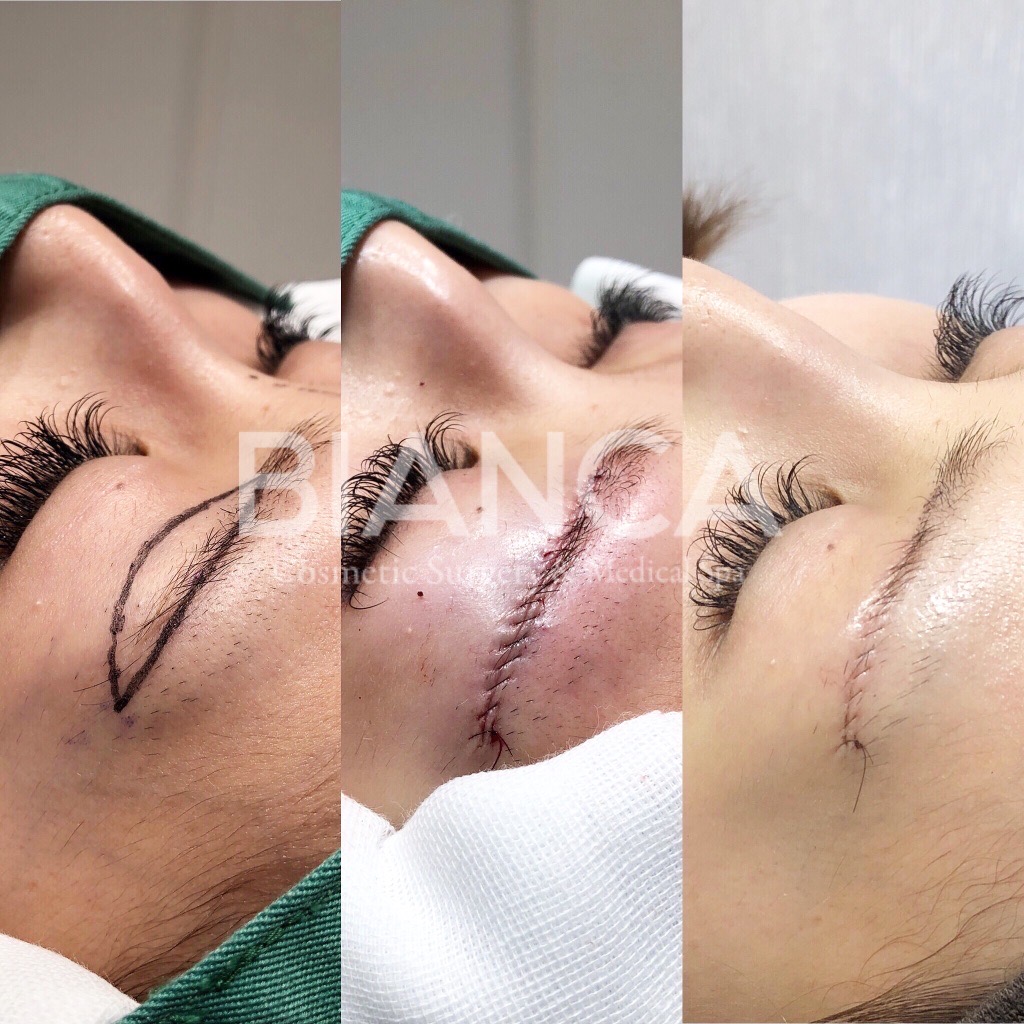 眉下切開でナチュラルに印象美をup！