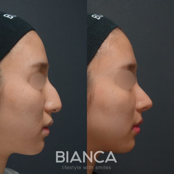 BIANCA CLINICの鷲鼻修正のbefore・after