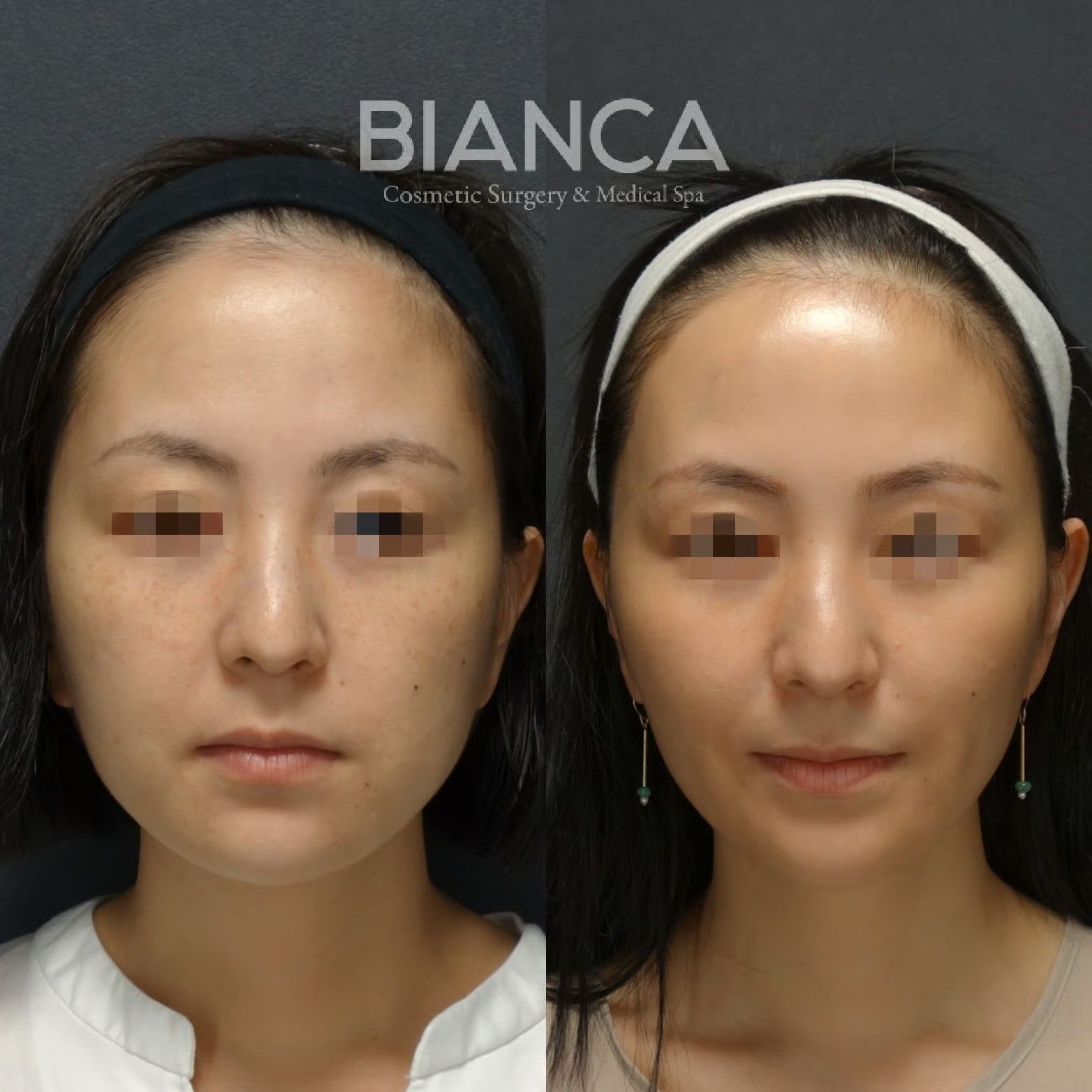 BIANCA LIFT（糸リフト各種）