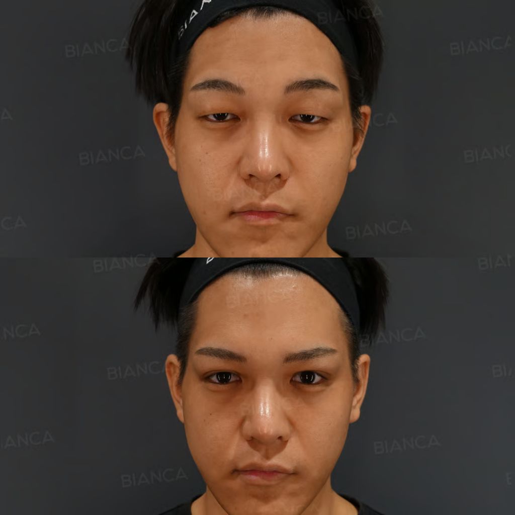 眼瞼下垂 切開法・MT法 ｜銀座・表参道にあるBIANCA CLINIC ビアンカ