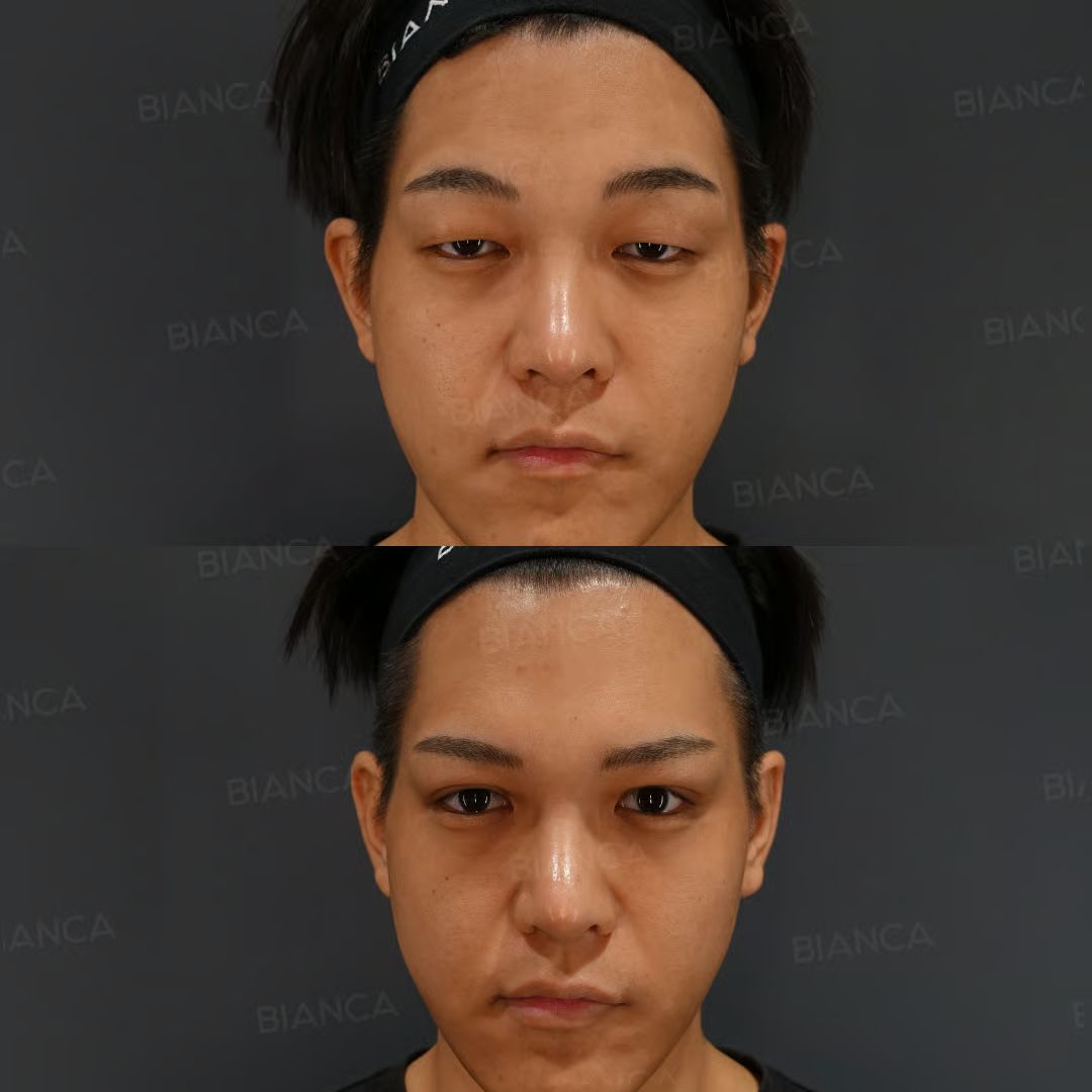 眼瞼下垂 切開法・MT法