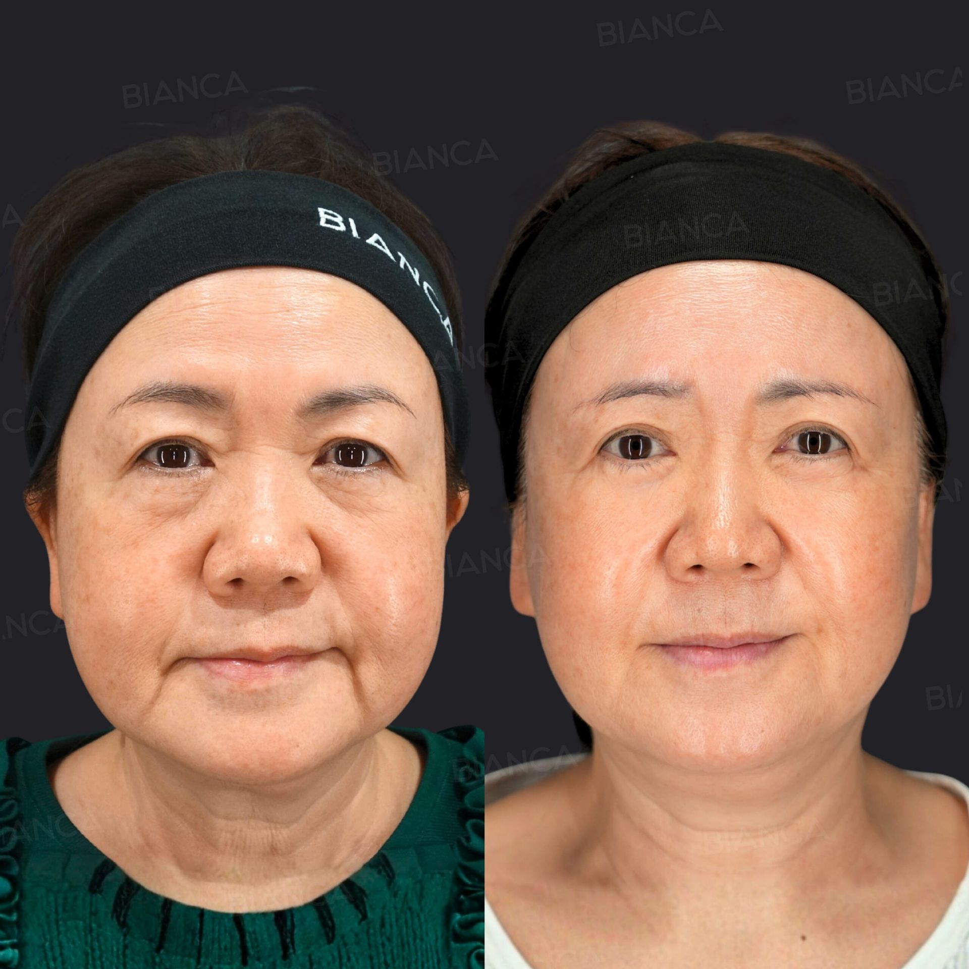 ミッドフェイスリフト（骨膜下）、眉下リフト（眉下切開）、SMASフェイスリフト