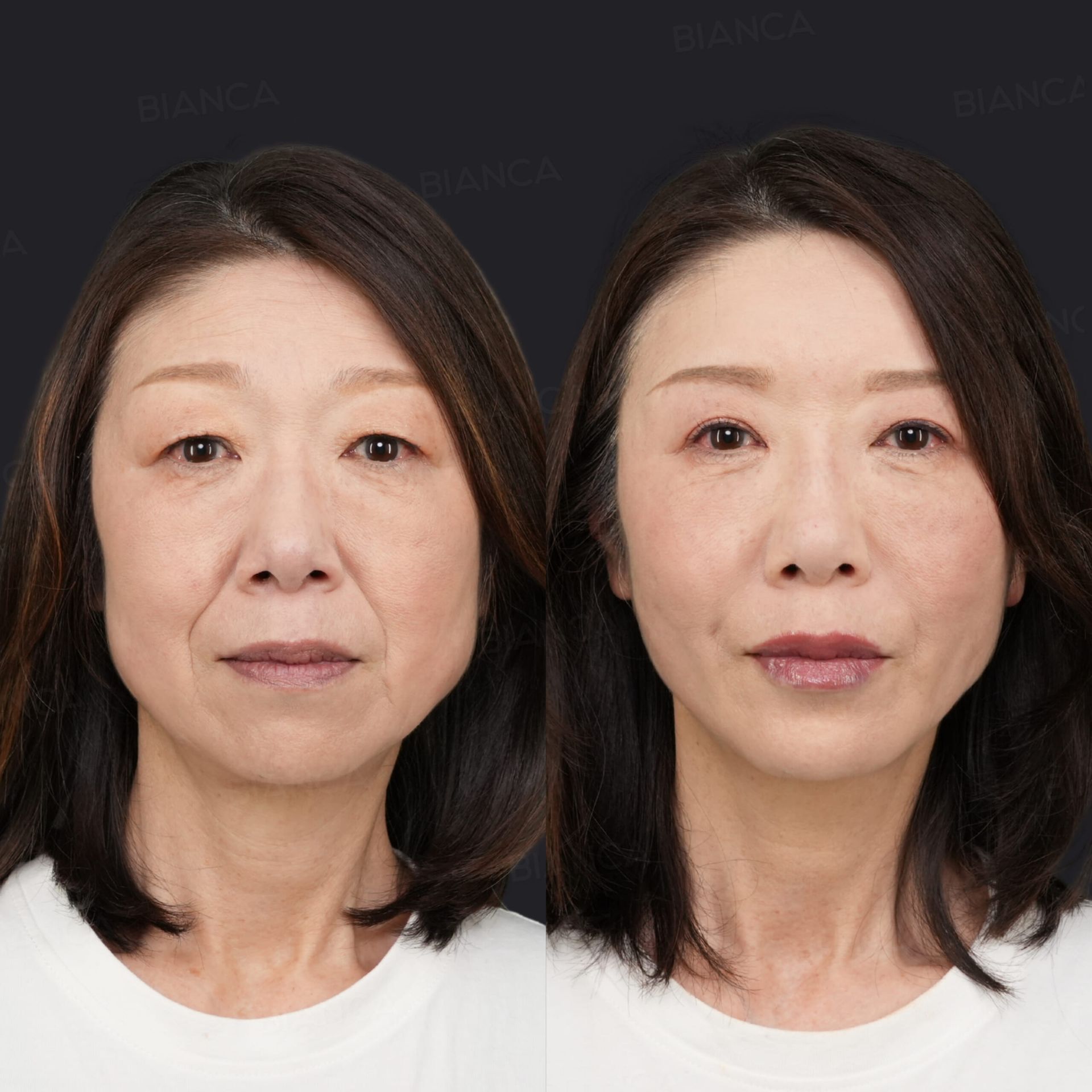 眉下切開、上瞼脂肪取り、脂肪吸引、脂肪注入、アルテミスリフト、目の下クマたるみ取り、ヒアルロン酸注射、ボトックス注射