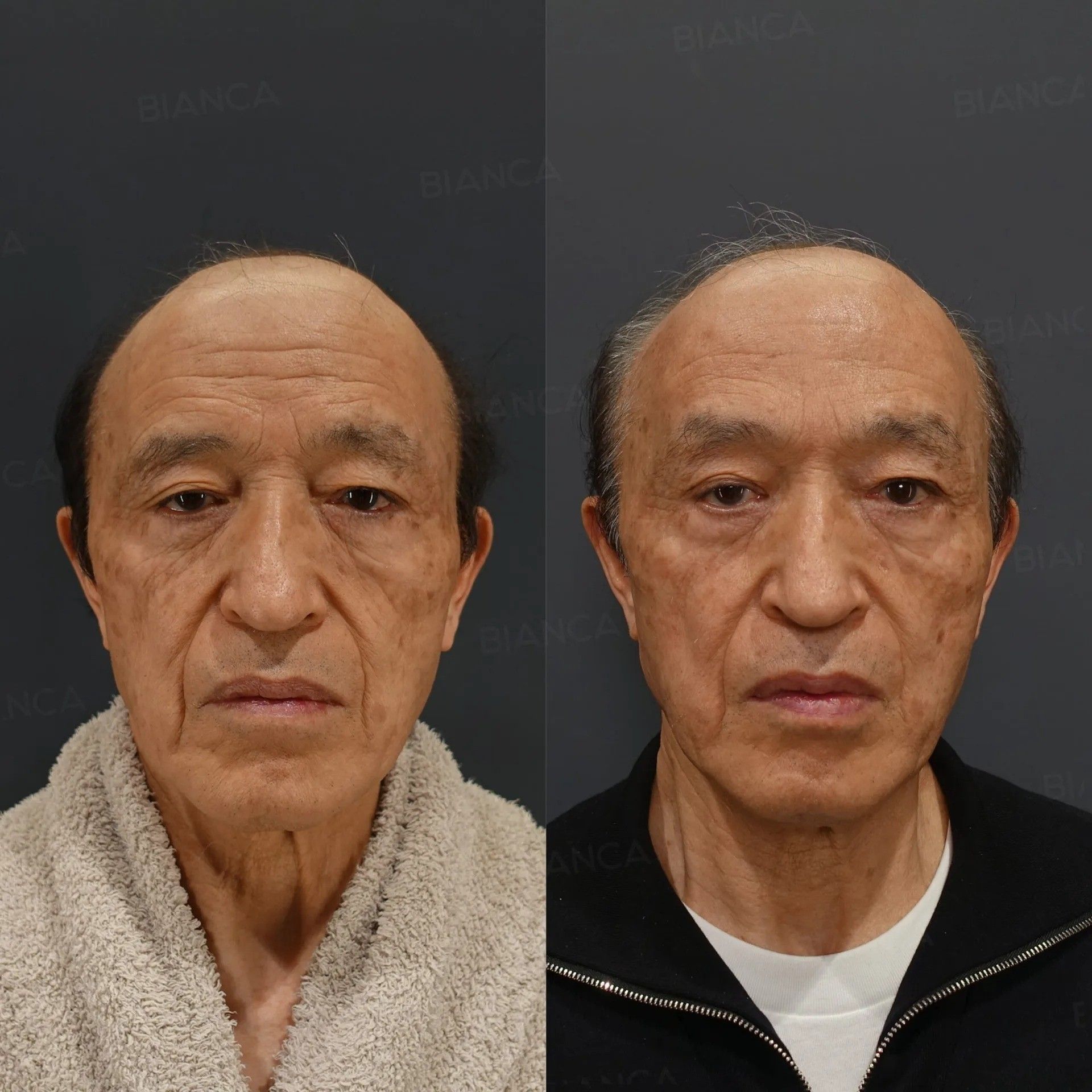 前額リフト