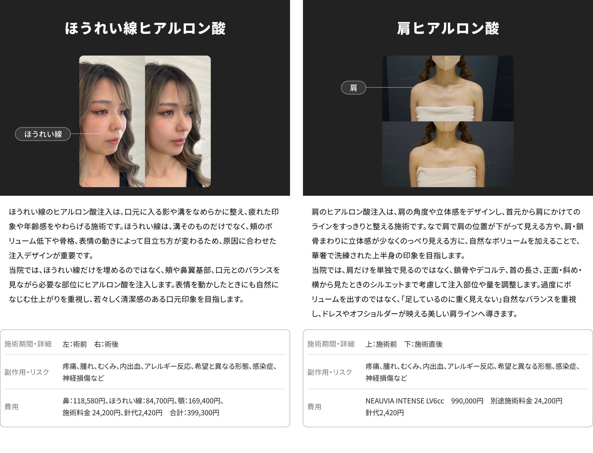 銀座・表参道のBIANCA CLINIC ほうれい線ヒアルロン酸注射と肩ヒアルロン酸注射の症例