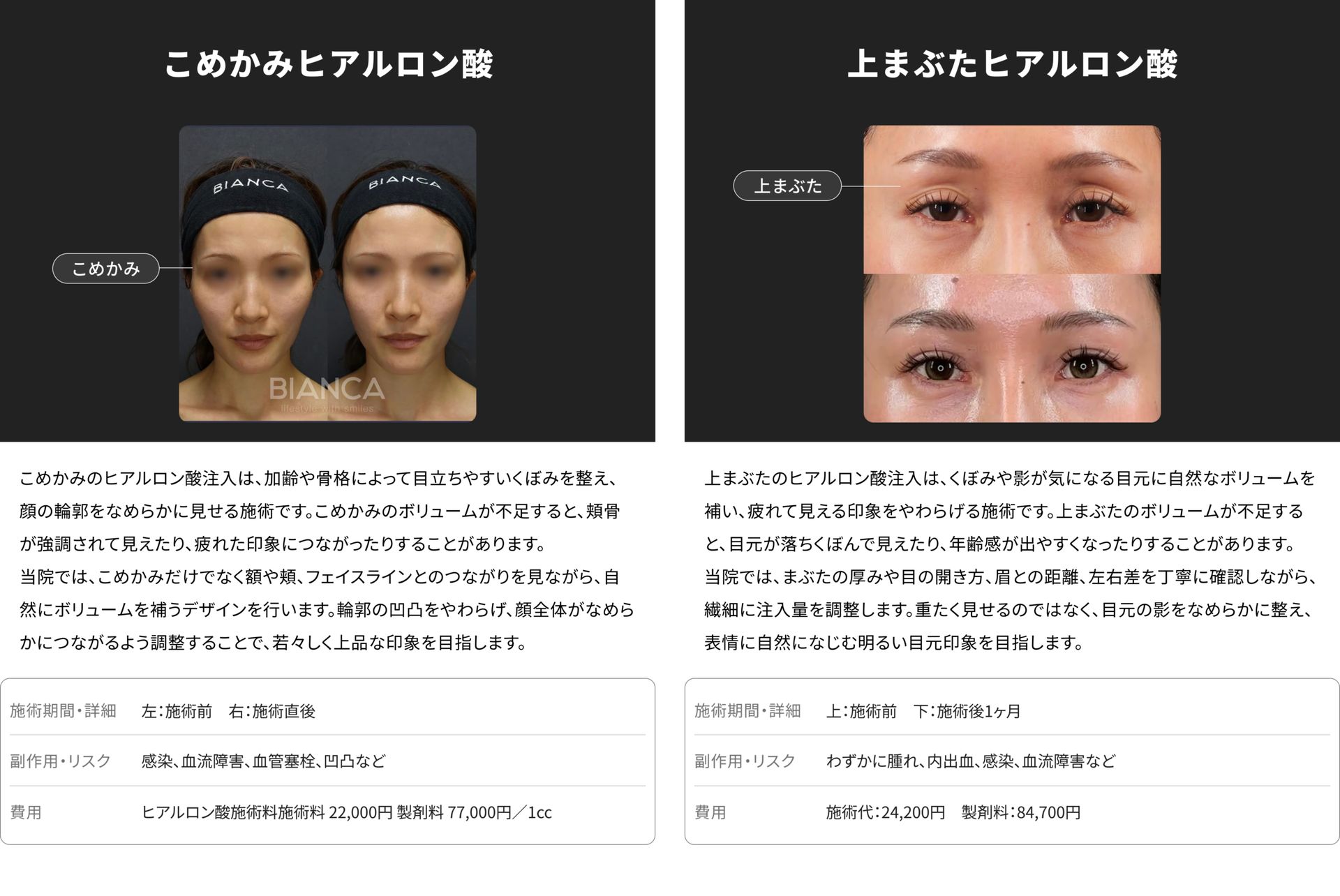 銀座・表参道のBIANCA CLINIC こめかみヒアルロン酸注射と上まぶたヒアルロン酸注射の症例