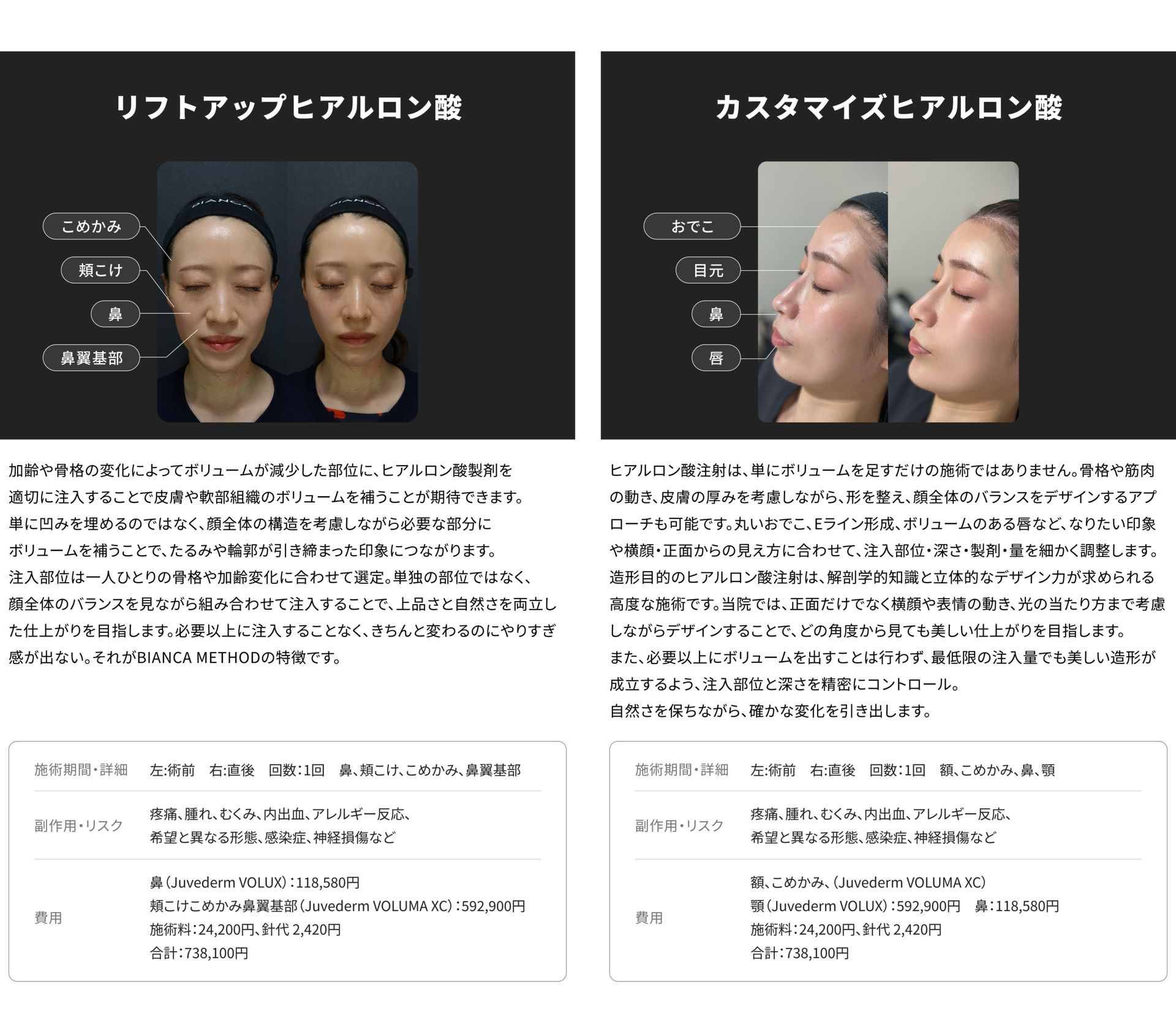銀座・表参道のBIANCA CLINIC リフトアップヒアルロン酸注射とカスタマイズヒアルロン酸注射の症例