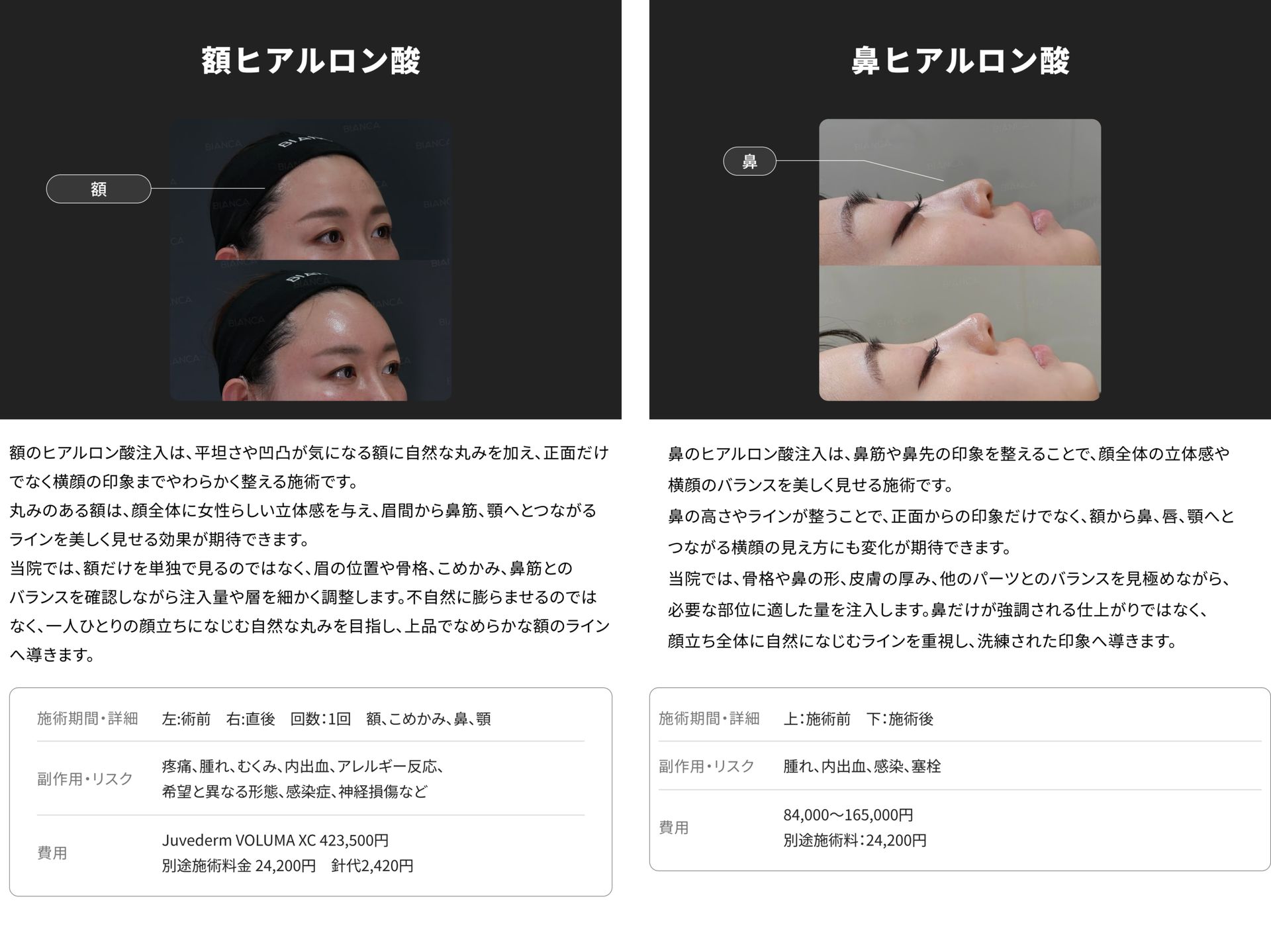 銀座・表参道のBIANCA CLINIC 額ヒアルロン酸注射と鼻ヒアルロン酸注射の症例