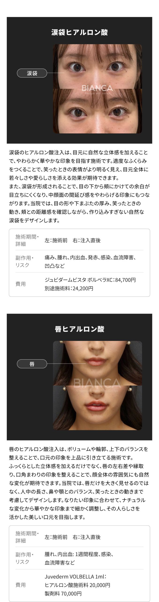 ヒアルロン酸注射 銀座・表参道にあるBIANCA CLINIC ビアンカ
