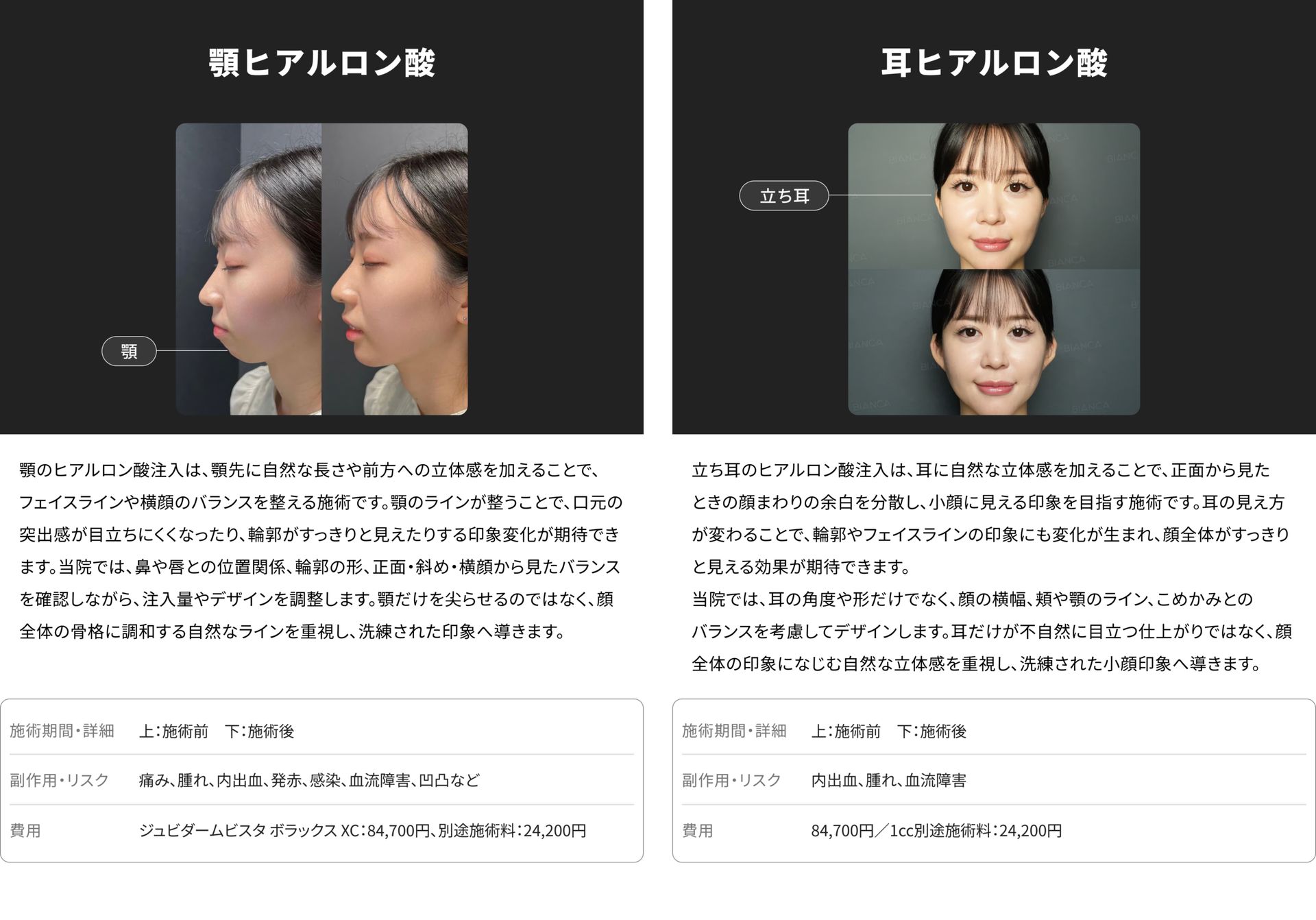 銀座・表参道のBIANCA CLINIC 顎ヒアルロン酸注射と立ち耳ヒアルロン酸注射の症例