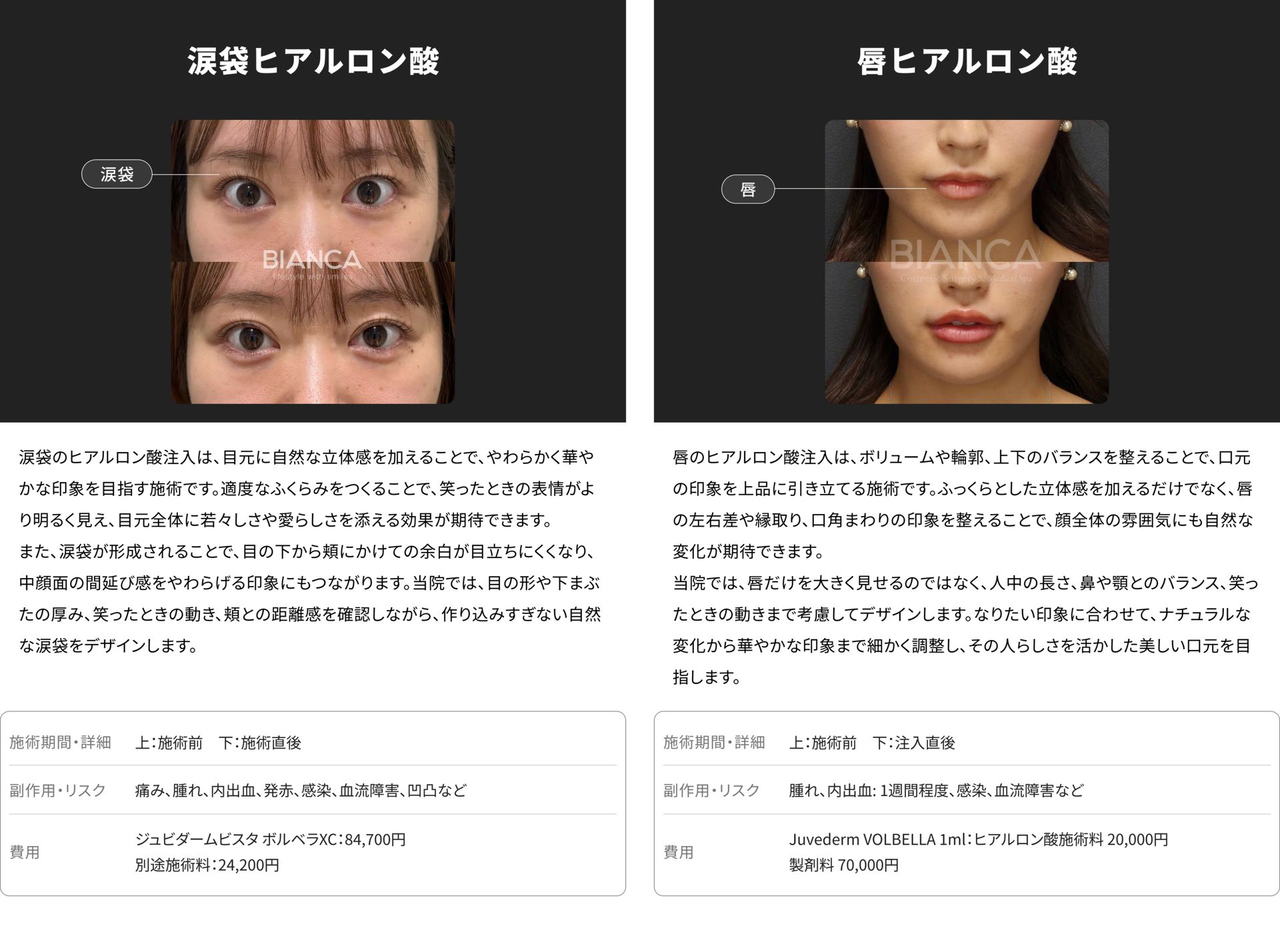 銀座・表参道のBIANCA CLINIC 涙袋ヒアルロン酸注射と唇ヒアルロン酸注射の症例