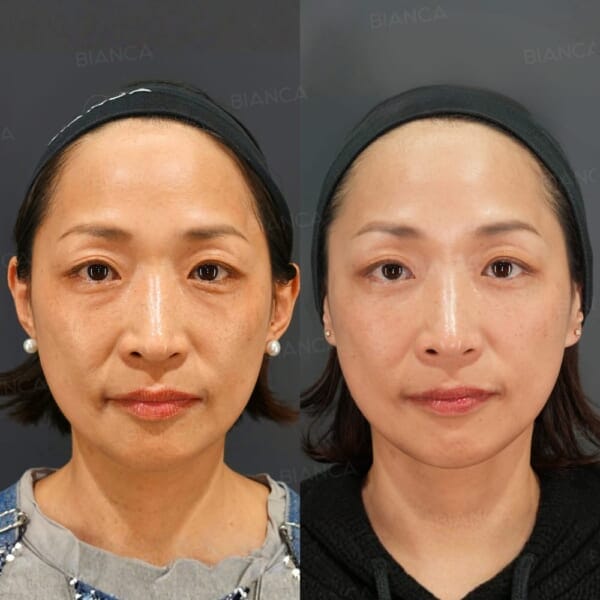 BIANCA CLINICのミッドフェイスリフトのbefore・after