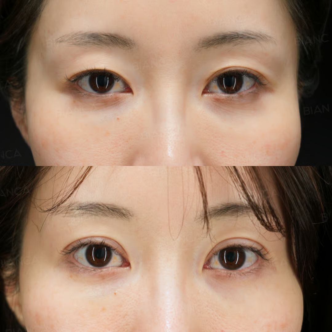 二重埋没法 自然癒着法
