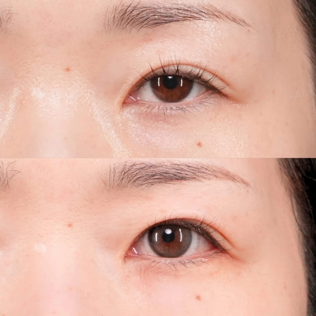 タレ目尻切開｜銀座・表参道にあるBIANCA CLINIC ビアンカクリニック