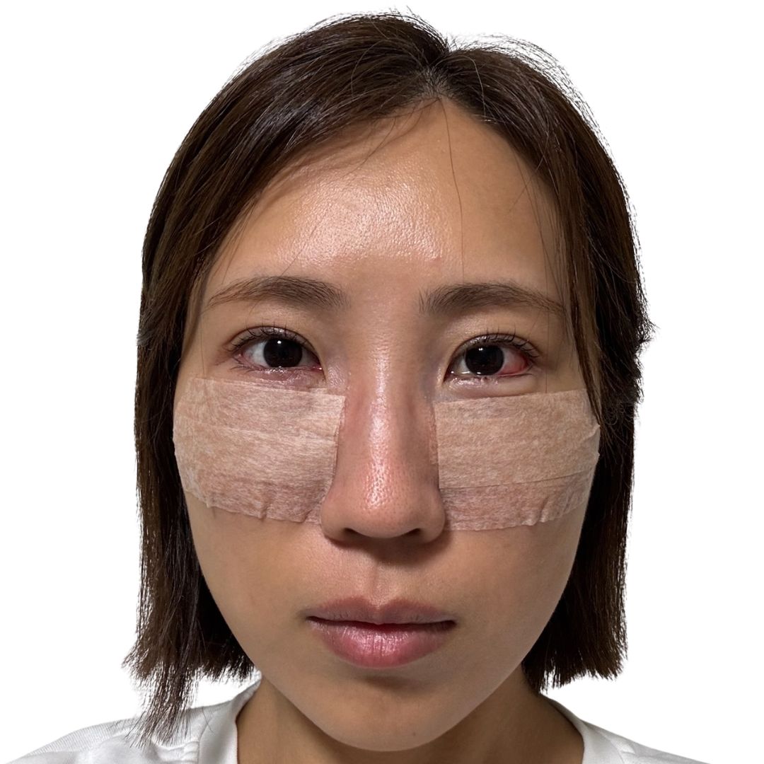 裏ハムラ法