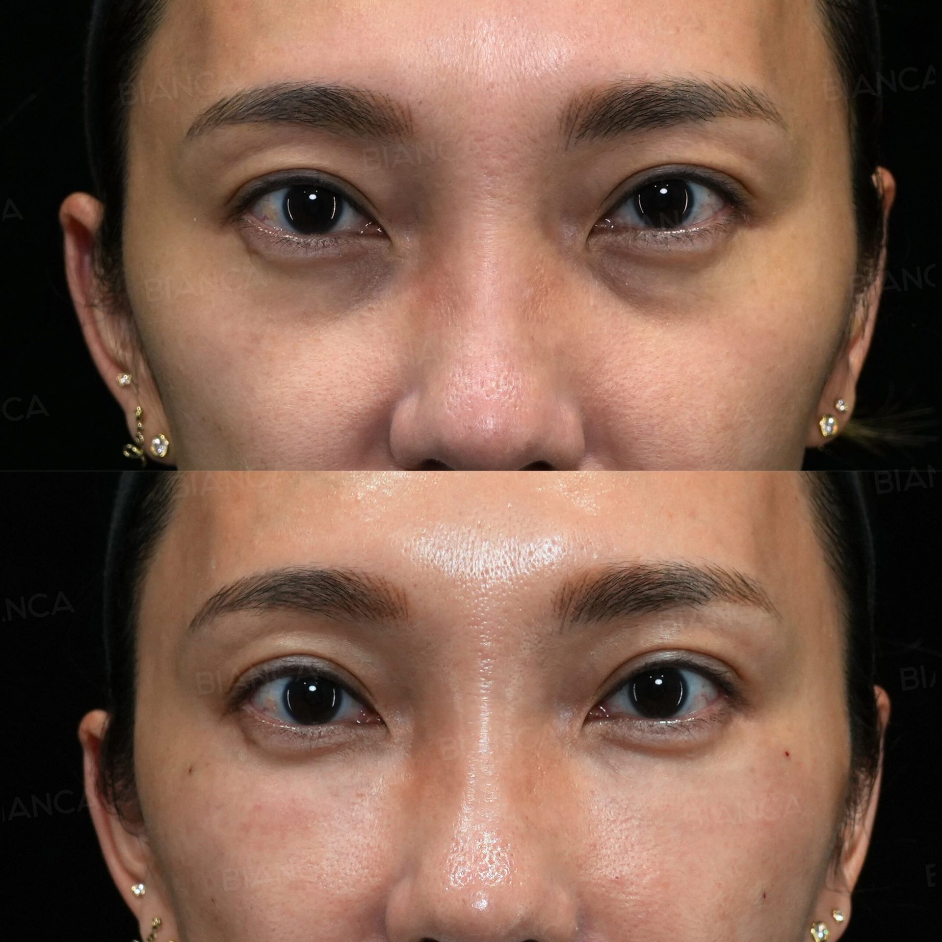 ezGEL（PRF）
