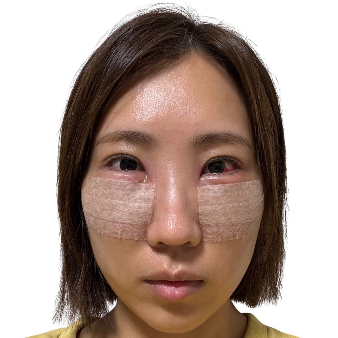裏ハムラ法