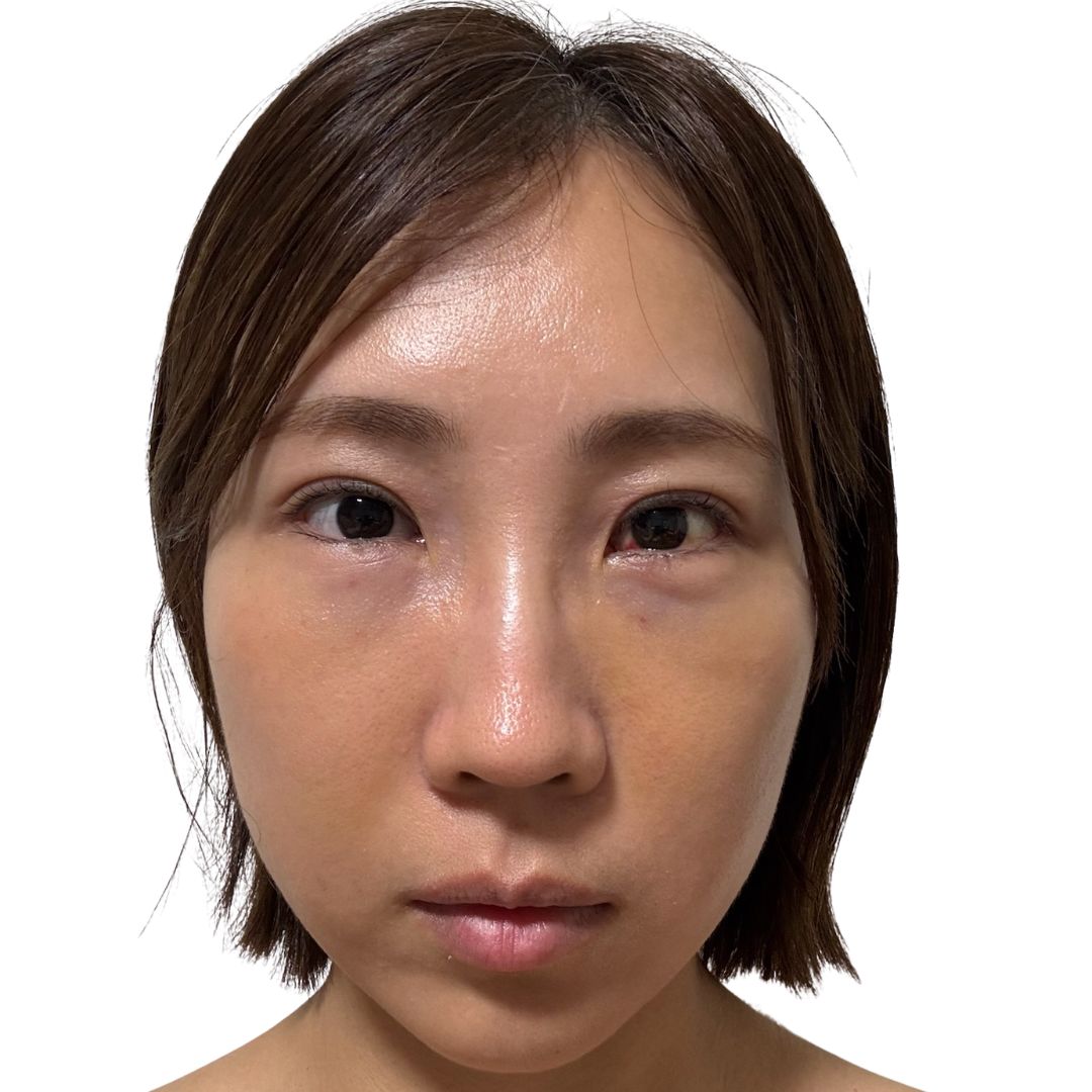 裏ハムラ法
