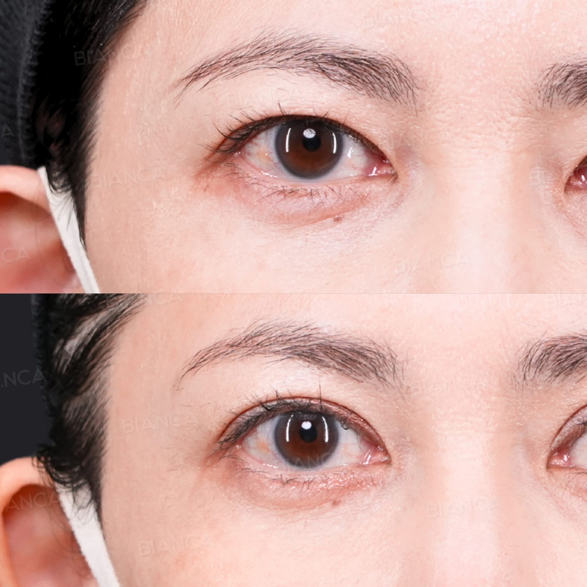 二重切開、上瞼たるみ取り