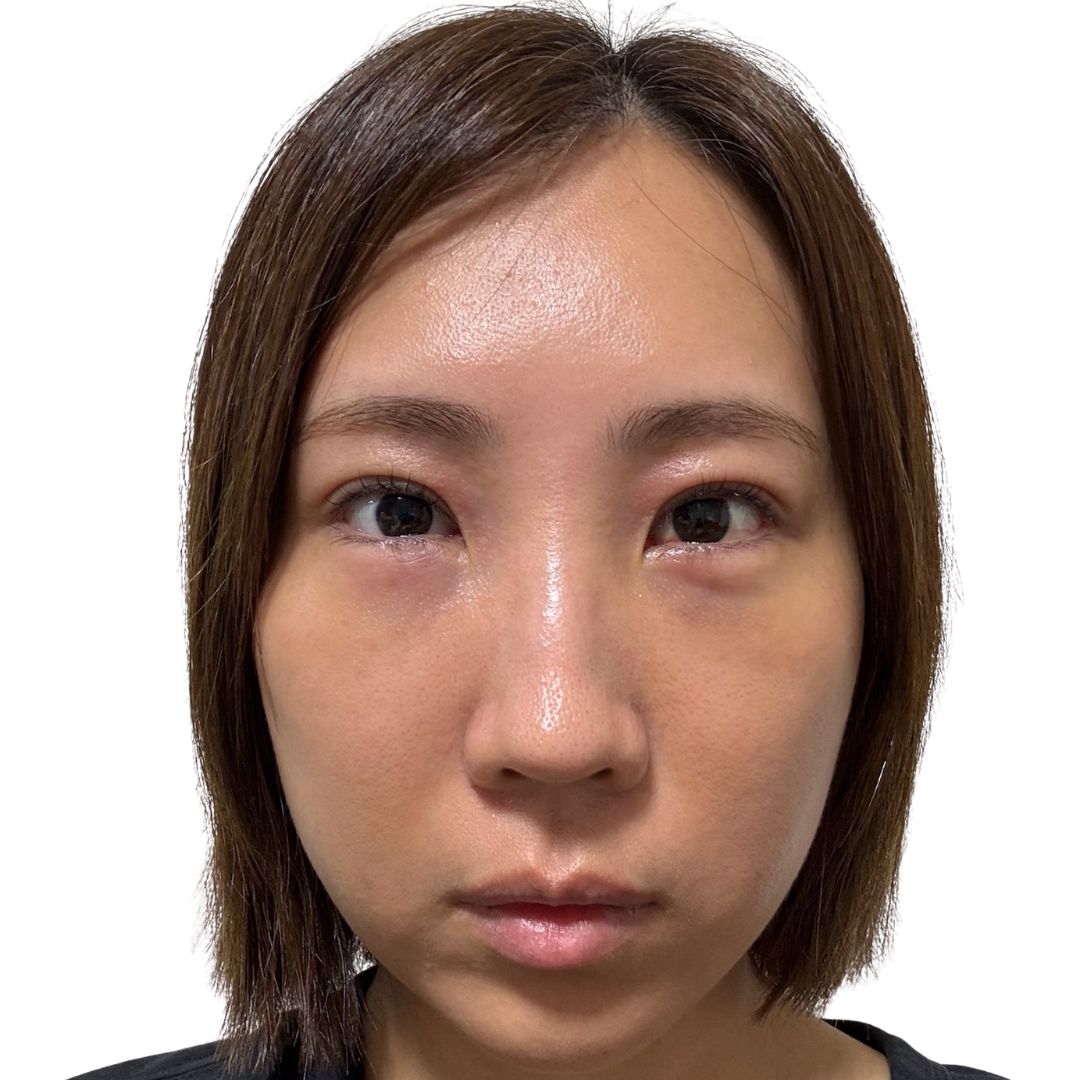 裏ハムラ法