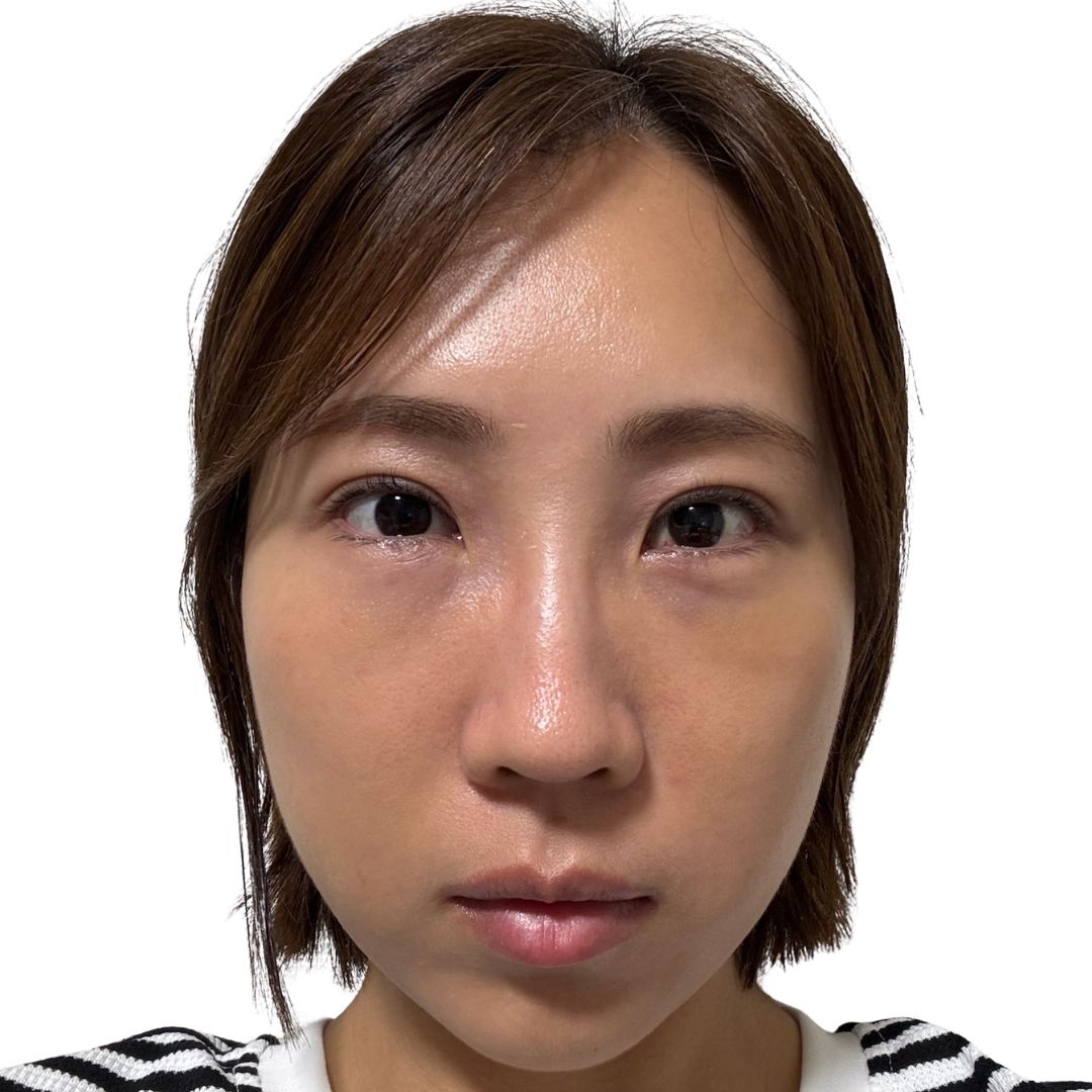 裏ハムラ法