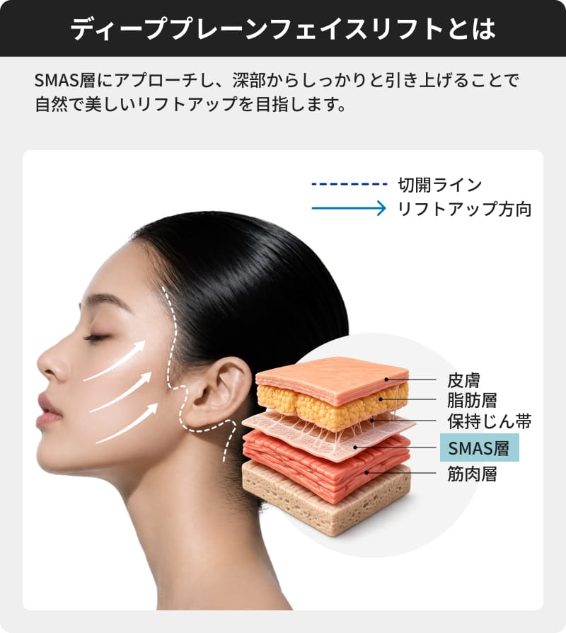 ディーププレーンフェイスリフトとは