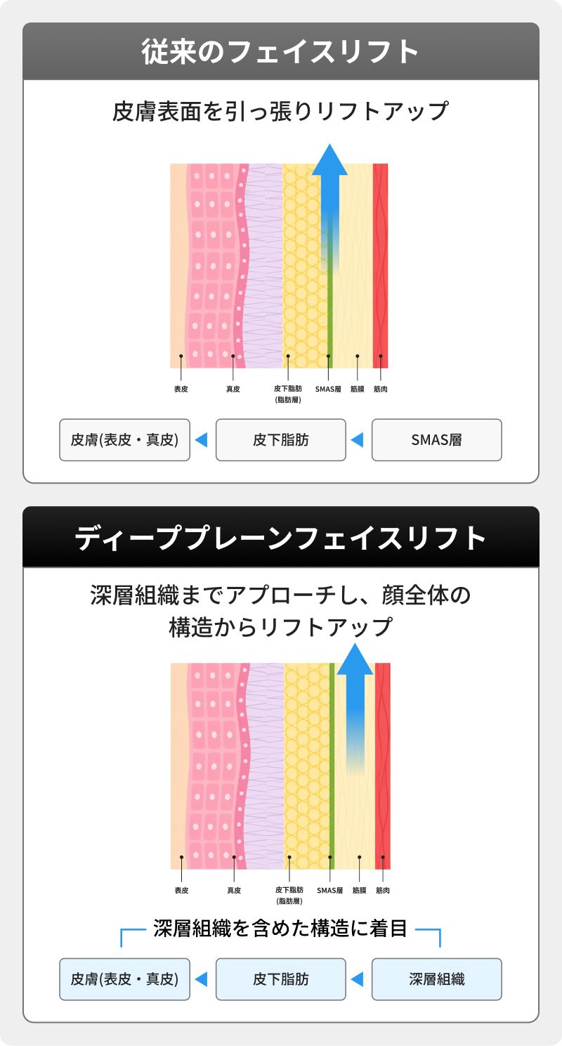 従来のフェイスリフトよりも自然な仕上がり